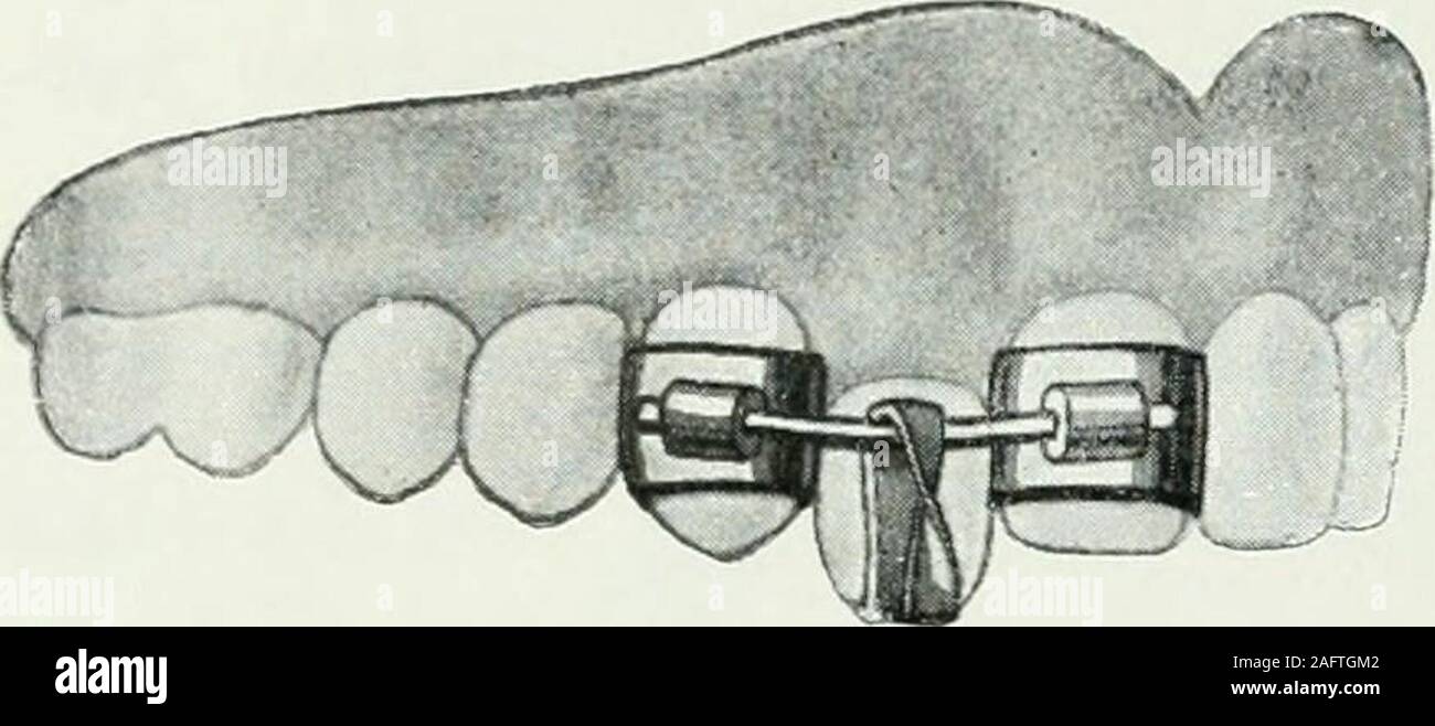 . Lehrbuch der orthodontie fur studierende und zahnartze mit enschluss der geschichte der orthodontie. Fig. 141. meiden, mehrere Zähne zu Hülfe ziehen. Das ist in dem ab-gebildeten Falle dadurch erreicht, daß zwei Zähne des Unter-kiefers mit Bändern versehen sind, von denen das eine Band miteinem Querbügel — Bänder und Bügel sind aus Neusilber —direkt verlötet ist, während das andere eine Kanüle trägt. Indiese Kanüle wird das freie, rechtwinklig umgebogene Ende desQuerbügels eingeschoben. Der Gummiring ist einerseits um denKnopf stift, andererseits um den Querbügel gelegt. Es versteht sich von Stock Photo