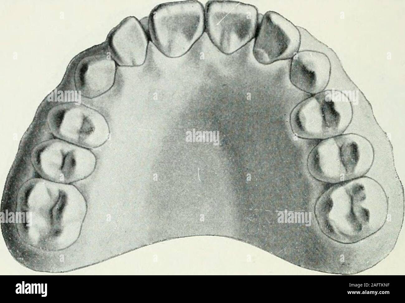 . Lehrbuch der orthodontie fur studierende und zahnartze mit enschluss der geschichte der orthodontie. Fig. 126. mußten. Ohne Fixation ist ein Rückfall aber unvermeidlich. Imübrigen ist allerdings klar, daß durch die Siegfriedschen Federnbedeutende Kräfte ausgeübt werden können, die Federn also fürähnliche Fälle sehr zu empfehlen sind. ß) Lingualwärts durchgebrochene Zähne. Fig. 125 168 II. Therapie der Anomalien. gibt einen Fall wieder, in dem es galt, den rechten oberen,innerhalb des Zahnbogens durchgebrochenen, Eckzahn in dierichtige Lage zu bringen. Da der Unterkiefer bereits vor den. Fig. Stock Photo