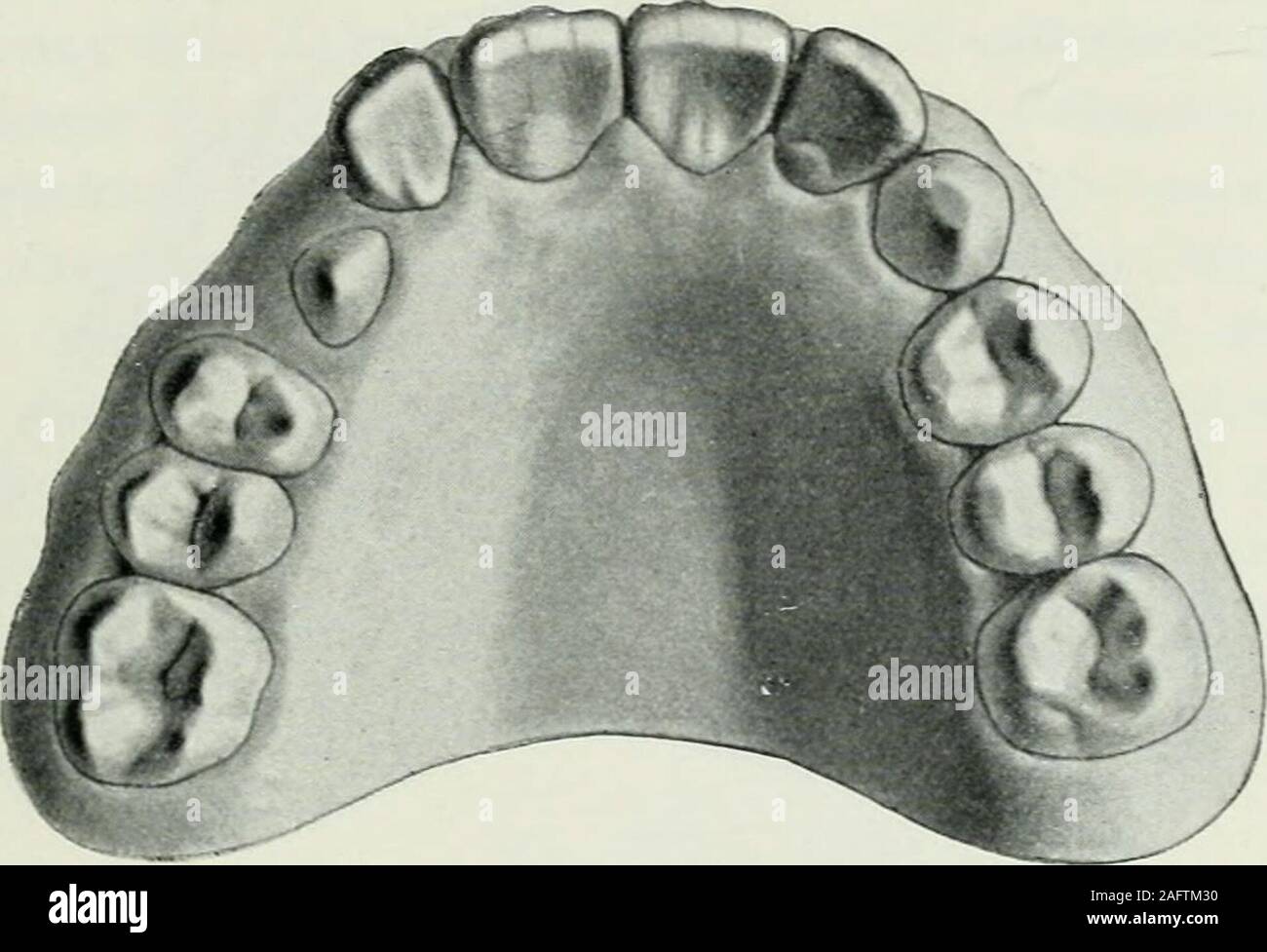 . Lehrbuch der orthodontie fur studierende und zahnartze mit enschluss der geschichte der orthodontie. Fig. 124. wendung elastischer Federn charakterisiert ist (vgl. Kap. überdas Drehen der Zähne). Die Abbildung ist nach einem Sieg-friedschen Modelle hergestellt. Das Band um den zweiten Prä-molaren wird durch einen an der labialen Seite angelötetenBügel an der Drehung verhindert. Die Wirkungsweise der ander labialen Seite angebrachten Feder erklärt sich von selbst.Die Feder müßte indessen zum mindesten den Eckzahn besser 3. Spezielle Behandlung einzelner Hauptklassen von Anomalien. 167 tangier Stock Photo