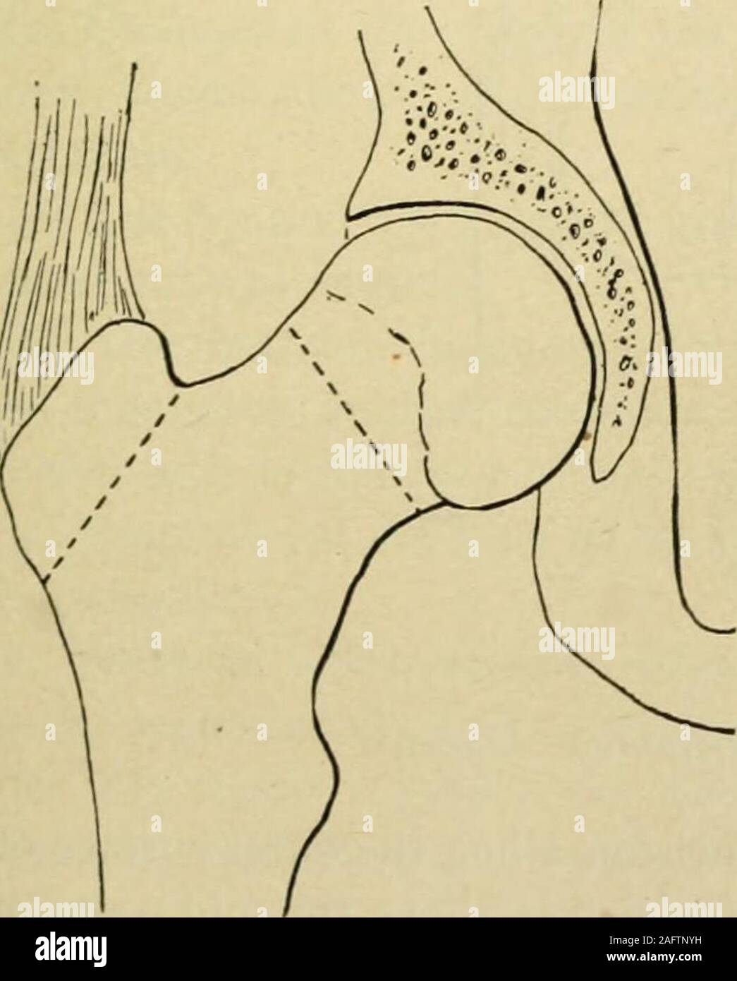 . Manual of operative surgery. Fig. 1242.—Whitmans operation. (Whitman.). Stock Photo