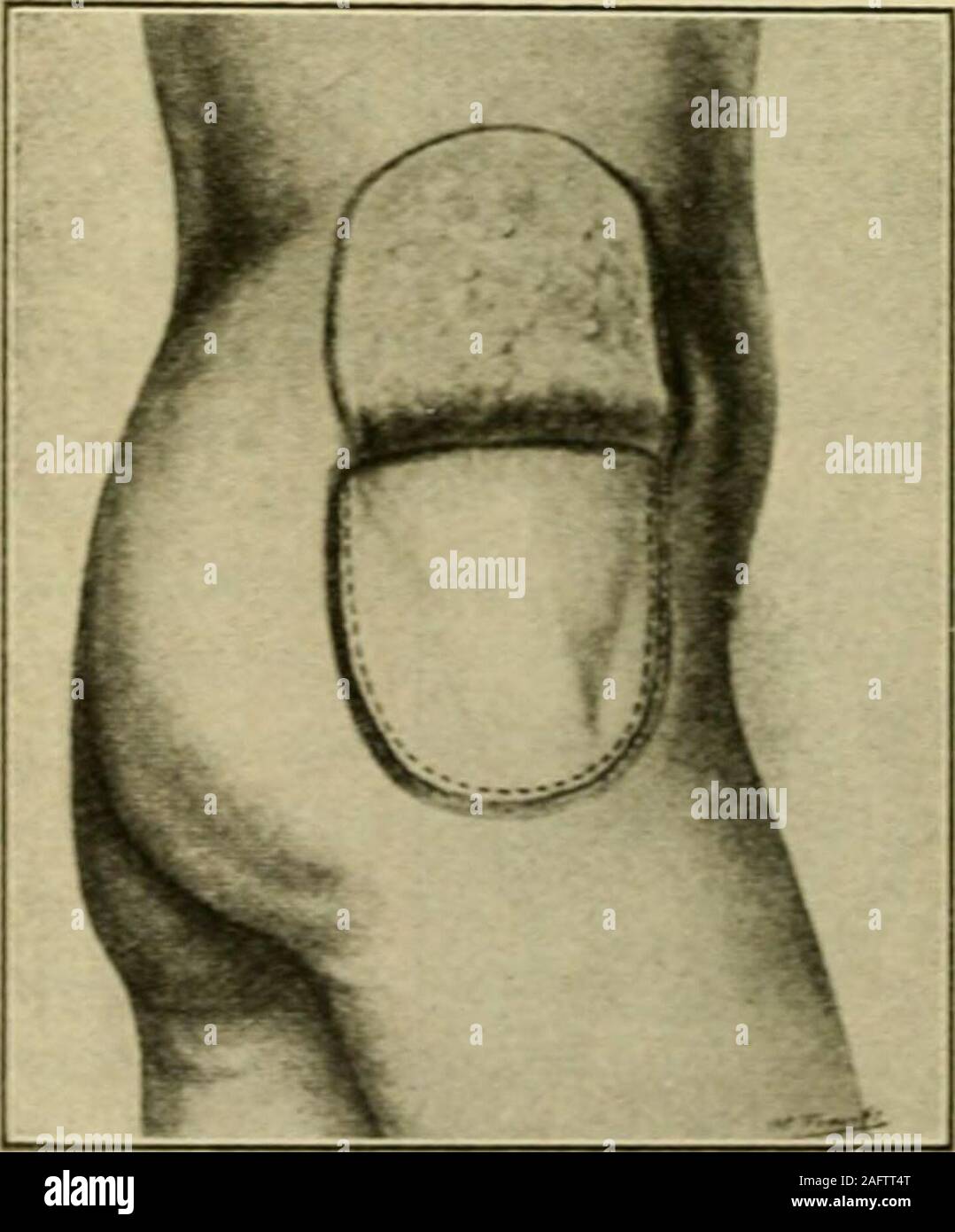 . Manual of operative surgery. Fig. i2iS.—Arthroplasty. [Murphy.). Stock Photo