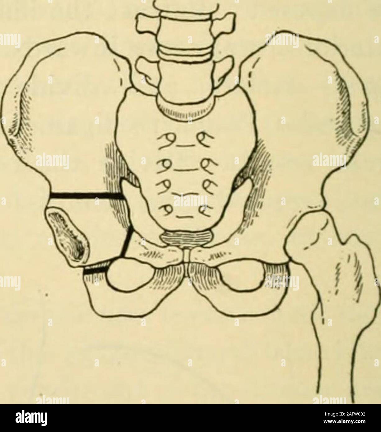 . Manual of operative surgery. Fig. 1193.—Excision of pubis. Fig. 1194.—Excision of acetabulum. Excision of Symphysis Pubis.—Tuberculous osteomyelitis affecting thepubic bones and the symphysis calls for early operation. The disease may beexposed by an incision directly over it; all affected bone cut away with chisel andmallet and all abscesses opened and curetted. If no distinct and separatedsequestrum is present v. Bunger recommends that a transverse incision be madeimmediately above the pubis, the soft parts separated and the bone dividedsubperiosteally beyond the disease (Fig. 1193). The r Stock Photo