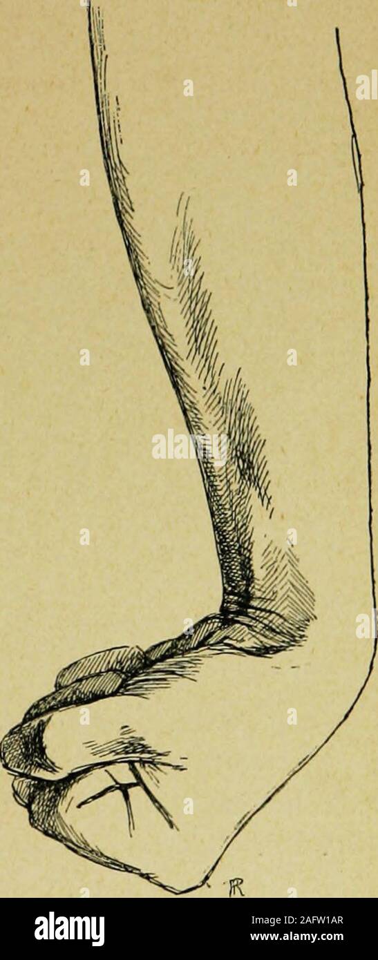 . Paralysies et contractures hystériques. Fig. 17. — Contracture hystérique. 18. — Contracture hystérique de la mainet du poignet. très relevée, et la malade porte exclusivement sur le talon. Cetteforme est rare : nous en avons observé un remarquable exemple(fig. 12). Dans ce cas, la contracture siégeait également au genouet à la hanche. Lorsque la contracture a envahi tout le membre inférieur, 158 DES PARALYSIES ET DES CONTRACTURES HYSTERIQUES lattitude dextension décrite plus haut (p. 10) est la plus vul-gaire. Lextension de la hanche et du genou coïncide le plus sou-vent avec le pied bot d Stock Photo