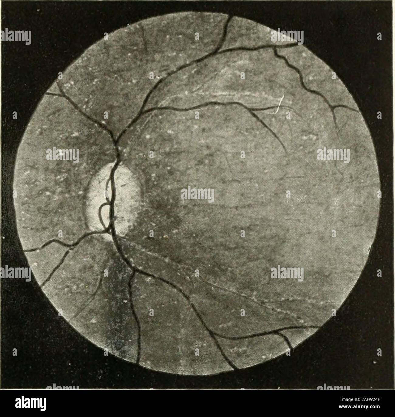. Oftalmología; estadística [1.]-3. ser. Fifí. B—o. D Rotura de coroides OfítiInittli&gt;f/i. Fig. A O. I. Embolia de arteria central de retina conAtrofia del nervio óptico y Sinchisis estrellada Stock Photo