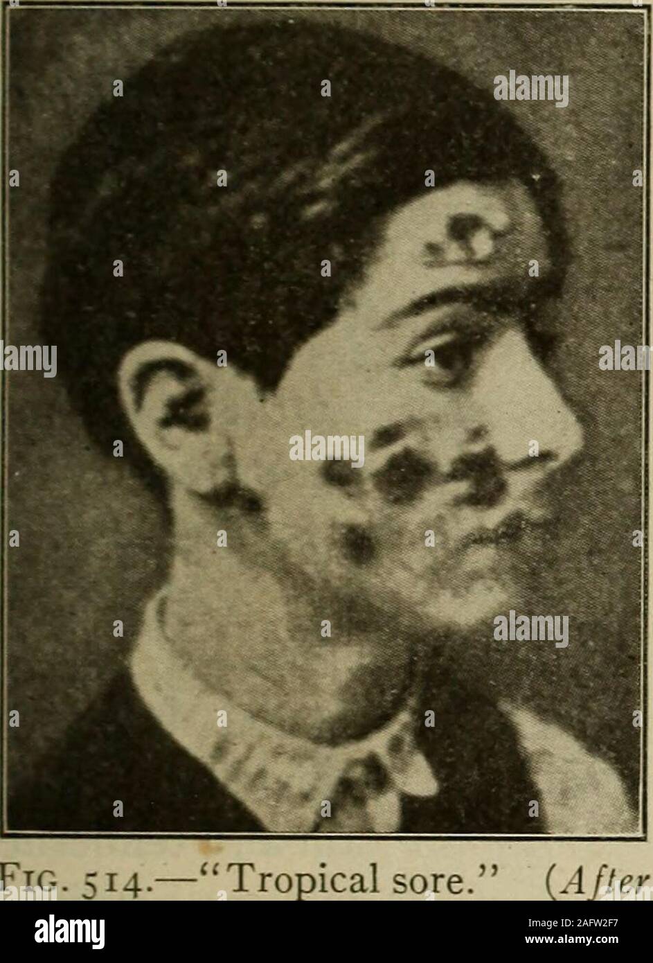 . Medical diagnosis for the student and practitioner. e on the site of some insect bite orslight wound or abrasion and during weeks or months gradually increasesin size and assumes the appearance of a sluggish furuncle. This stage is succeeded by one of persistent, painless, sluggishulceration. The boil may be solitary or there may be a score or even more. Healingusually takes place only after the lapse of six to eight months. This condition masquerades under a host of names, in addition to thosegiven above, e.g., Oriental sore, Bagdad sore, Bouton dOrient,Uta or Espundia (Peru), Bouba (Brazil Stock Photo