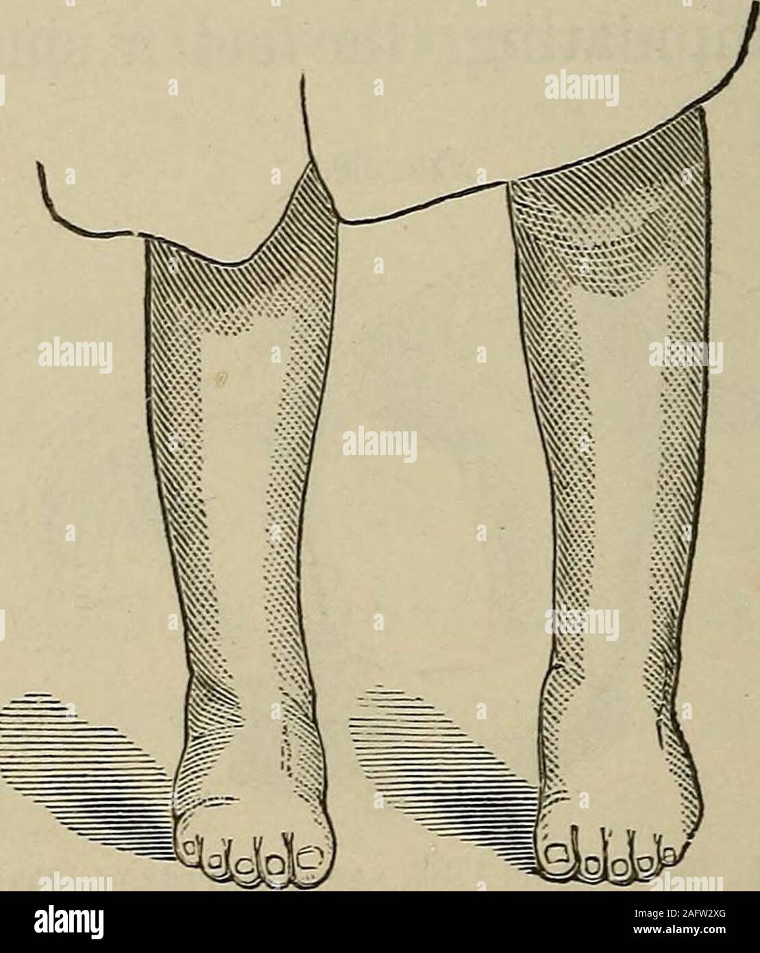 A Practical Manual Of The Treatment Of Club Foot C M September 1870 Aged Seventeen Days Being Satisfied That Deformity Was Of Paralyticorigin I Dressed Them With Neils Foot Board Asdescribed Page 39