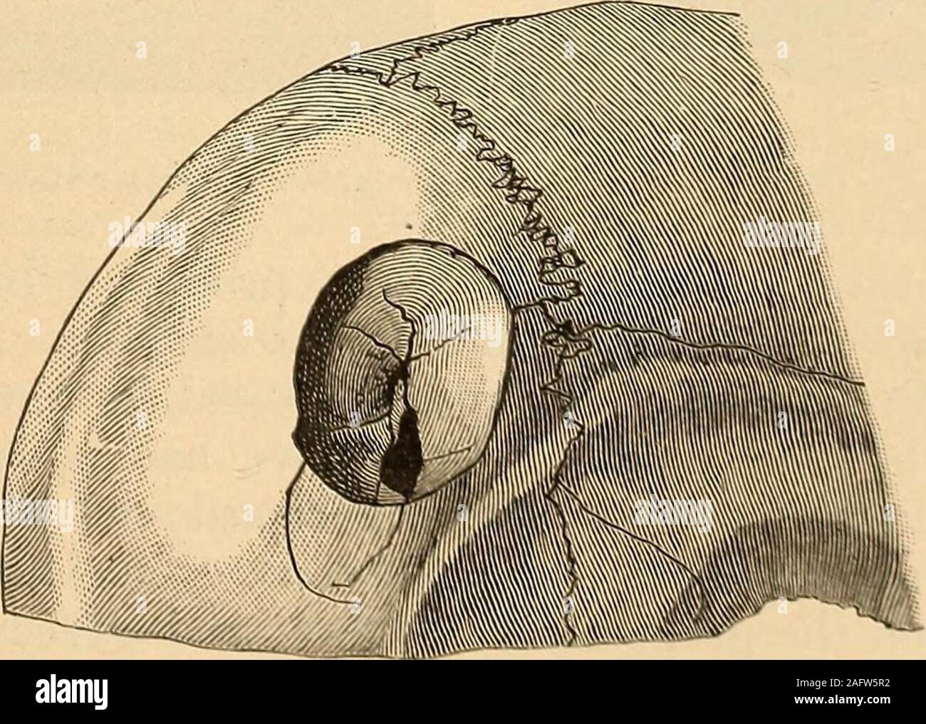 . A practical treatise on fractures and dislocations. Circumscribed fracture Avith iuclusion of hair. (Konig.) the dominant feature is the fracture and in which injury to the brainis usually absent or strictly localized. This feature is of so great prac-tical importance that I wish it might be indicated in the classifying Fig. 64.. Circuinscrihod dcprossiMl frjuturo. (Konu;.) nomenclature, to the exclusion, or at least the great subordination, o^^depression, which has long held the attention of the surgeon, to thehopeless conft)undiug of radically dillerent cases anil the useless or 138 FRACTU Stock Photo