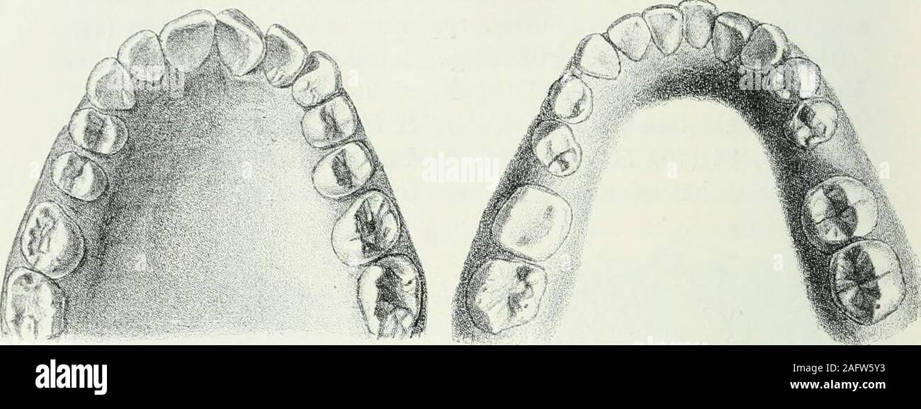 . Lehrbuch der orthodontie fur studierende und zahnartze mit enschluss der geschichte der orthodontie. nterkiefer der Fall, jedoch weniger beträchtlich. Extraktionder vier sechsjährigen Molaren, die zum Teil große Füllungentragen. Fig. 35. 36 (72, 73), derselbe Fall nach zwei Jahren. Inbeiden Kiefern Bikuspidaten zurück-. Molaren vorgerückt,alle Zwischenräume zwischen den genannten Zähnen sichtlicherweitert. Die Eckzähne, namentlich im Oberkiefer, fast voll-ends in den Zahnbogen eingerückt, wodurch dieser das eckigeAussehen verloren hat und abgerundet erscheint. An Stelle derextrahierten Molar Stock Photo