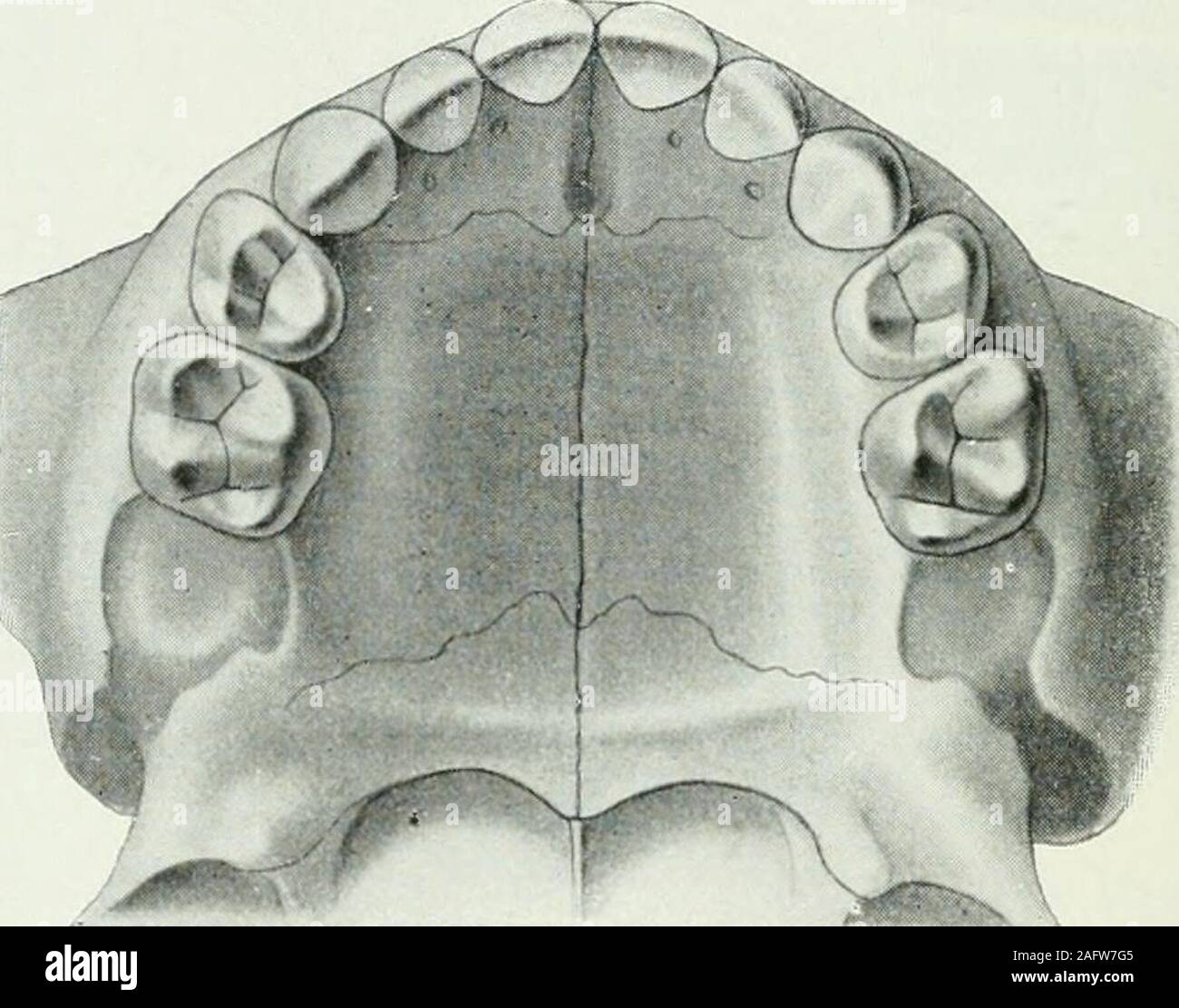 . Lehrbuch der orthodontie fur studierende und zahnartze mit enschluss der geschichte der orthodontie. erscheint. Schließlich kann der Oberkiefer durchkrankhafte Zustände in der Entwicklung zurückgeblieben sein,während der Unterkiefer sein normales Wachstum beibehalten 106 III. Ätiologie der Stellungsanomalien. hat. Es kann aber auch ein übermäßiges Wachstum des Unter-kiefers, dessen Grund ebenfalls meist pathologisch sein wird, dieSchuld am ganzen Übel tragen. Auch dem Aufbiß und Kreuzbiß liegen in den weitausmeisten Fällen dieselben Ursachen zugrunde. So beobachtenwir auch im Milchgebiß nich Stock Photo