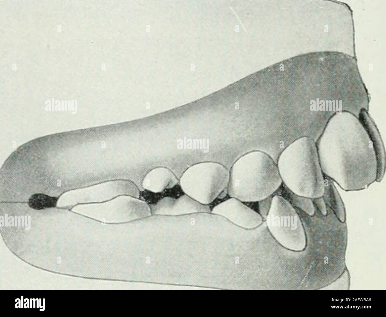 . Lehrbuch der orthodontie fur studierende und zahnartze mit enschluss der geschichte der orthodontie. Fig. 5.5. hinter die gleichnamigen unteren Zähne. Der Oberkieferbogenist zu klein, während der Unterkieferbogen übermäßig entwickeltist. Die Artikulation der Prämolaren und Molaren ist vielfachanormal, auch ist diese Deformität meist mit einer Verschiebungder Mittellinie verbunden. 76 II. Anomalien der Zähne. Für den nach innen geneigten Biß sind typisch die abge-flachten, eckigen Kieferbögen und das Aufbeißen der Schneide-. Fig. 56. flächen der oberen Frontzähne auf die labialen Halspartien Stock Photo