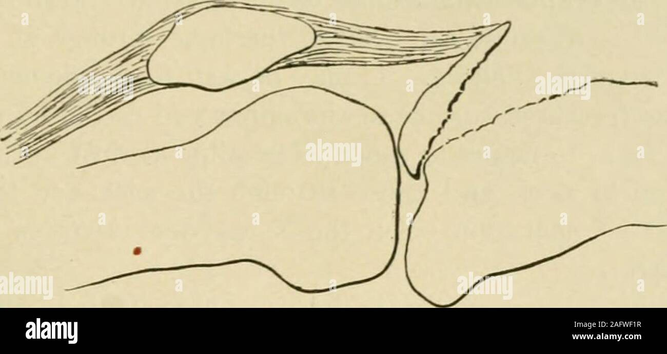 . Manual of operative surgery. d to the articular surface of the bone.The fractured fragment of bone may become wedged into the knee-joint(Fig. 1123). Operative Treatment.—5/e/&gt; i.—Freely expose the site of injury by a ver-tical or, better, by a horseshoe-shaped incision having its base above. If theknee-joint is involved, wash all blood-clots, etc., out of it. Step 2.—Reduce the fracture. To do this satisfactorily it may be necessaryto pass a strong suture transversely through the tendo patellae as a tractor. * For a full discussion of the accident and its treatment see Gaudier and Bouret, Stock Photo