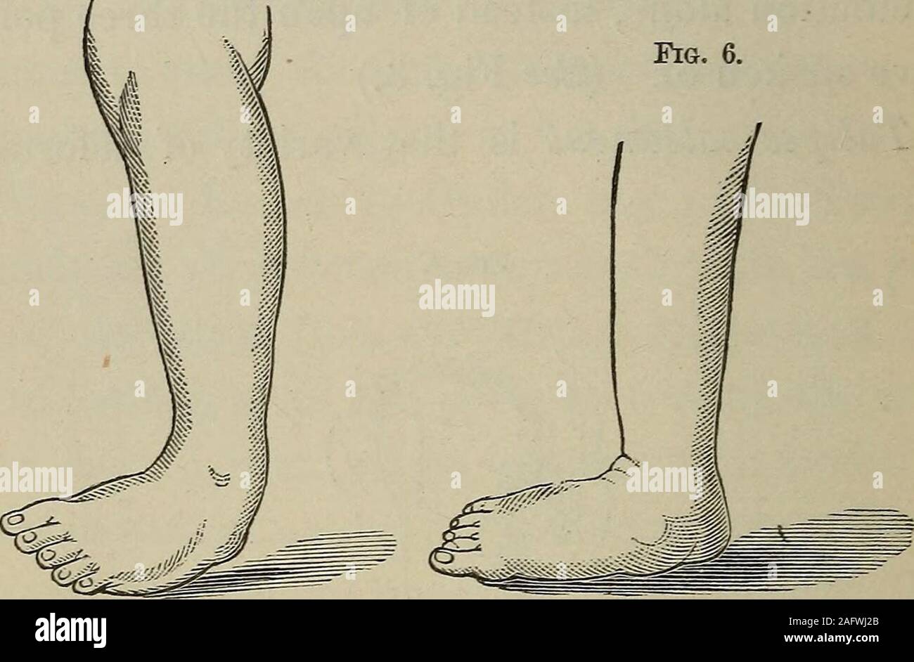 . A practical manual of the treatment of club-foot. Talipes Calcaneus. where the anterior portion of the foot is elevated,and the heel touches the ground. (See Fig. 4.) In talipes varus the foot is inverted and moreor less rotated, in such a manner as to bring its 20 WHAT IS TALIPES? inner surface upward and the outer edge to a great-er or less degree upon the ground. (See Fig. 5.) Fig. 5. Fig. 6.. Talipes Varus. Talipes Valgus. Talipes valgus presents the converse of thiscondition, the inner border of the foot being down-ward. {See Fig. 6.) Typical examples of any of these varieties oftalipes Stock Photo