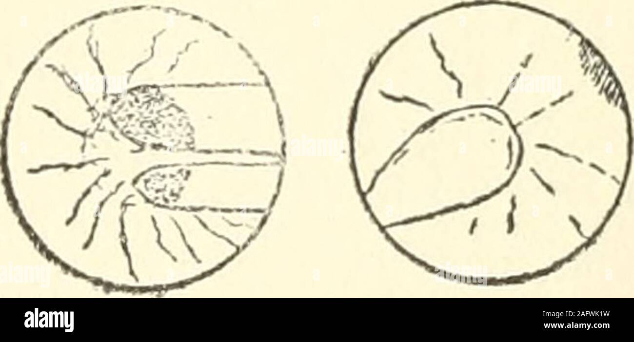 . Oftalmología; estadística [1.]-3. ser. Fig. 131.-Coloboma in-completo del iris. Fio. 132.—otro colobo-ma incompleto. ANOMALÍAS congenitas de la uvea. Coloboma del iris.—Dos casos de Coloboma Incompleto: pupi-las piriformes abajo y mono-culares; una mujer blancaen O. D. y un varón, blancoen O. D. Véanse los graba-dos. Un coloboma binocu-lar inferior en una blanca.Coloboma completo.—Un varón blanco, tenía coloboma exten so, interno en ambos ojos, simple en O. I., dividido por brida central en O. D.; había además catarata central.He anotado como caso dudoso una negra con leucomas y coloboma iri Stock Photo