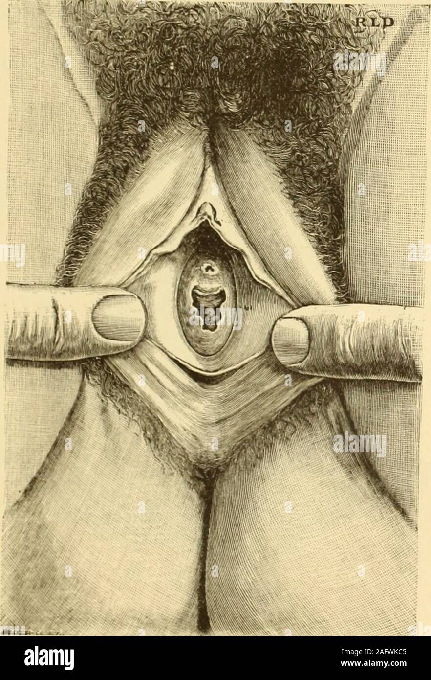 Hymen with double orifice. 