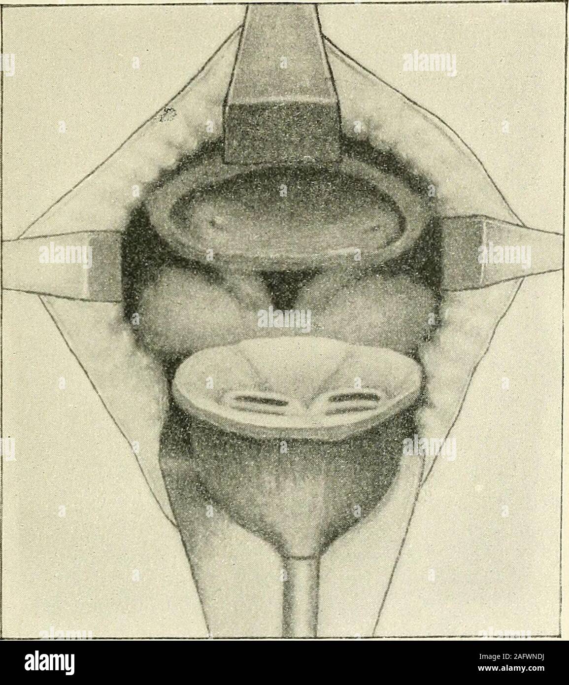 Studies On Hypertrophy And Cancer Of The Prostate Esicles 4 Cm Of The Vasadeferentia And A Cuff Of The Bladder 1 Cm Wide Along The Anterior Andlateral Surfaces And 2 Cm Studies On Hypertrophy And Cancer Of The Prostate Esicles 4 Cm Of The Vasadeferentia And A Cuff Of The Bladder 1 Cm Wide Along The Anterior Andlateral Surfaces And 2 Cm