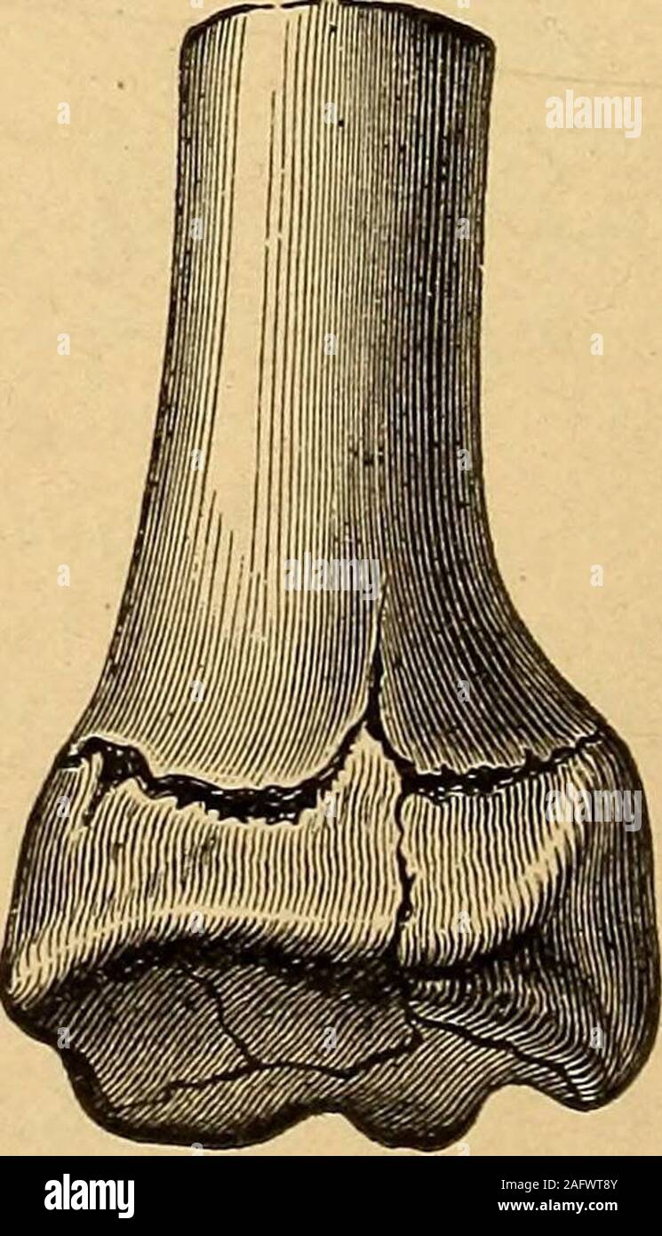 . A practical treatise on fractures and dislocations. Comminuted fracture of the femur,with splitting of the condyles. Comminuted fracture of the lowerend of the radius. Palmar aspect. PATHOLOGY. 29 down the innumerable fine lamellae of bone and forcing out the fatwithin the meshes, as a handful of snow or a wet sponge is compressed,and the result is equivalent to an actual loss of tissue; that is, if themain fragments are replaced in their original positions a gap is leftbetween them corresponding to the position and extent of the crushing.This gap is often too large to be filled by new bone, Stock Photo