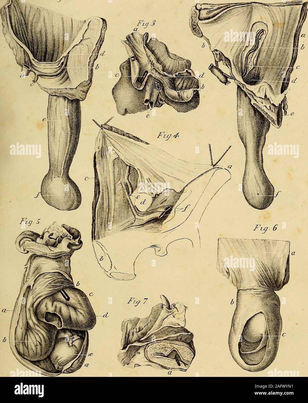 . The anatomy and surgical treatment of abdominal hernia. 4. Represents the division of the epigastric artery, in a case of stran-gulated oblique inguinal hernia.—The preparation wassent to me by Mr. Lawrence. a. Spine of the iliumv b. Pubes. c. Rectus muscle. d. Mouth of the hernial sac. e. Extremities of the divided epigastric artery.f. Femoral vessels.—See cases. 49 386 EXPLANATION OF PLATE X. Fig. 5. Exhibits intestine strangulated by omentum.a a. Congenital hernial sac cut open.b b. Omentum adhering to the bottom of the sac. c. Bougie passed under the constricting band of omentum. d. Inte Stock Photo