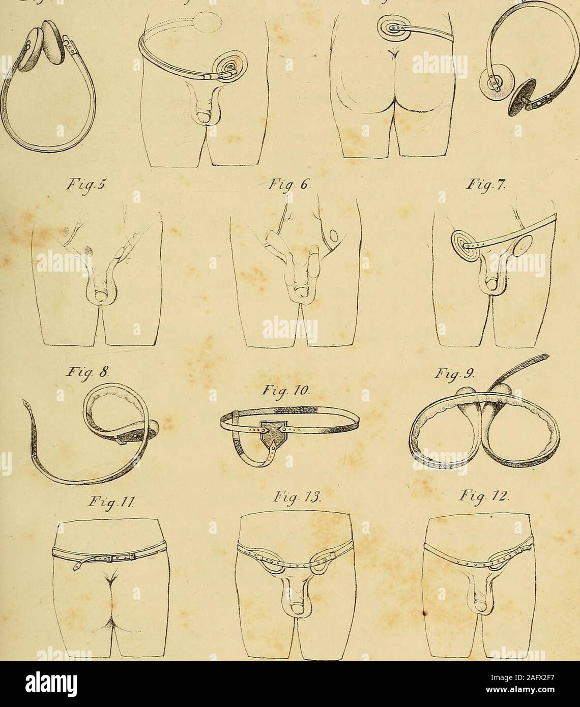 . The anatomy and surgical treatment of abdominal hernia. e lower part of the spine is shown. In this truss nocircular or thigh strap are required. Fig. 4. Salmon and Odys truss divested of its covering to show its balland socket apparatus, and the contrivance by which thespring can be lengthened or shortened at pleasure. Fig. 5. Represents the two apertures through which an oblique herniadescends, and the situation of the epigastric artery; belowPouparts ligament on the left side, is pointed out the part onwhich a truss should be applied for a femoral hernia. Fig. 6. Oblique hernia passing th Stock Photo