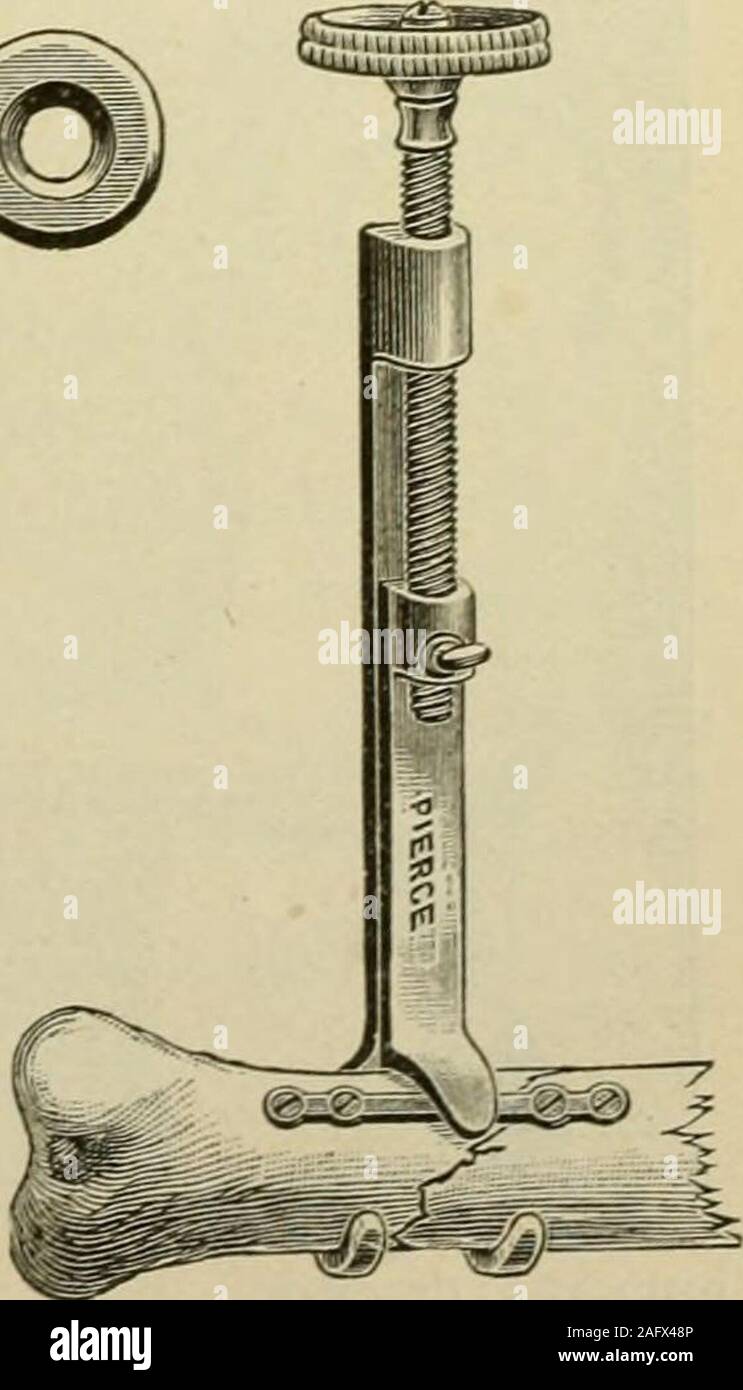 Manual of operative surgery. Fig. 1037.—Shermans vanadium steel