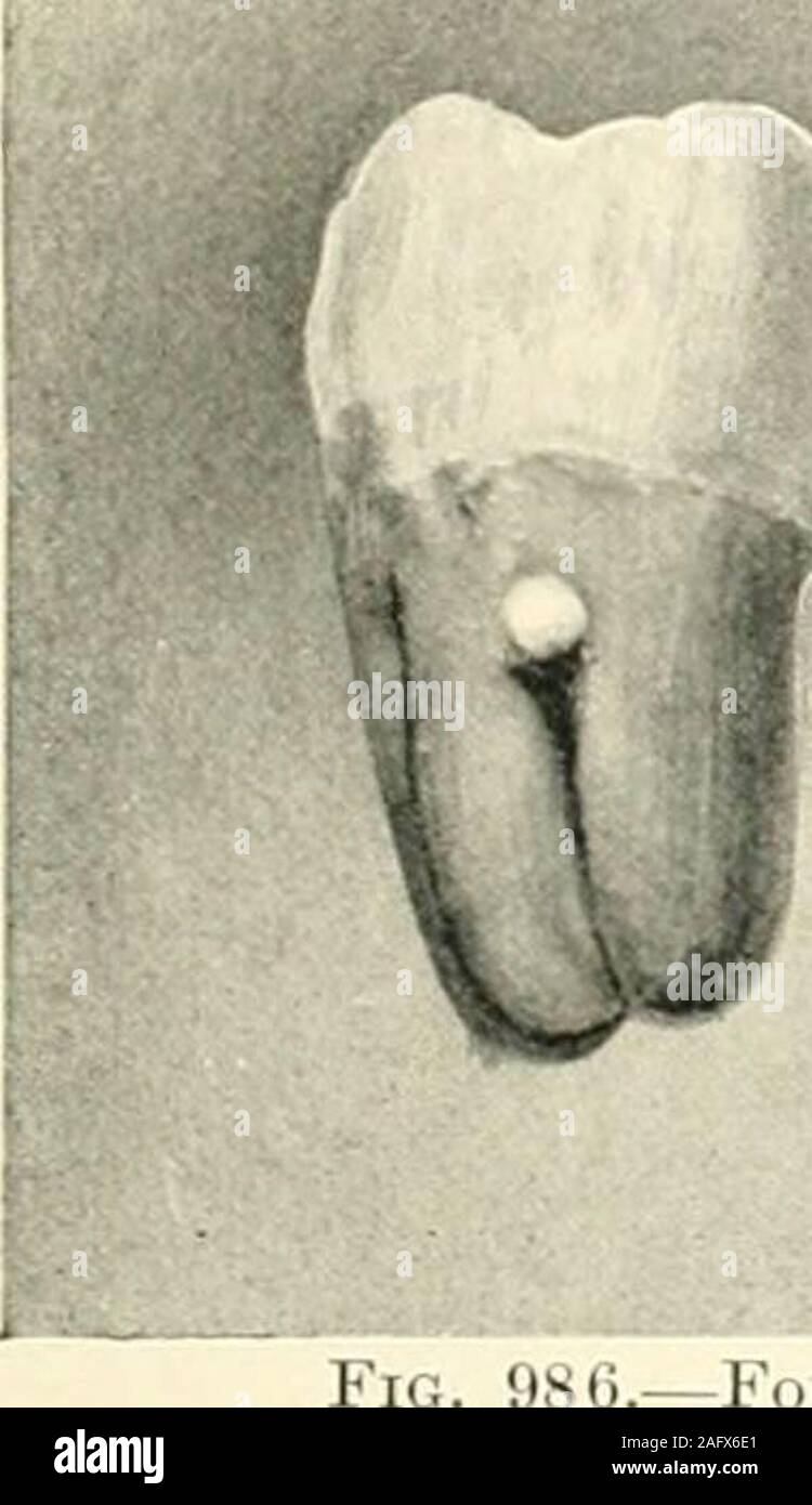 Projecting Tooth Projecting nodules hi-res stock photography and images - Alamy