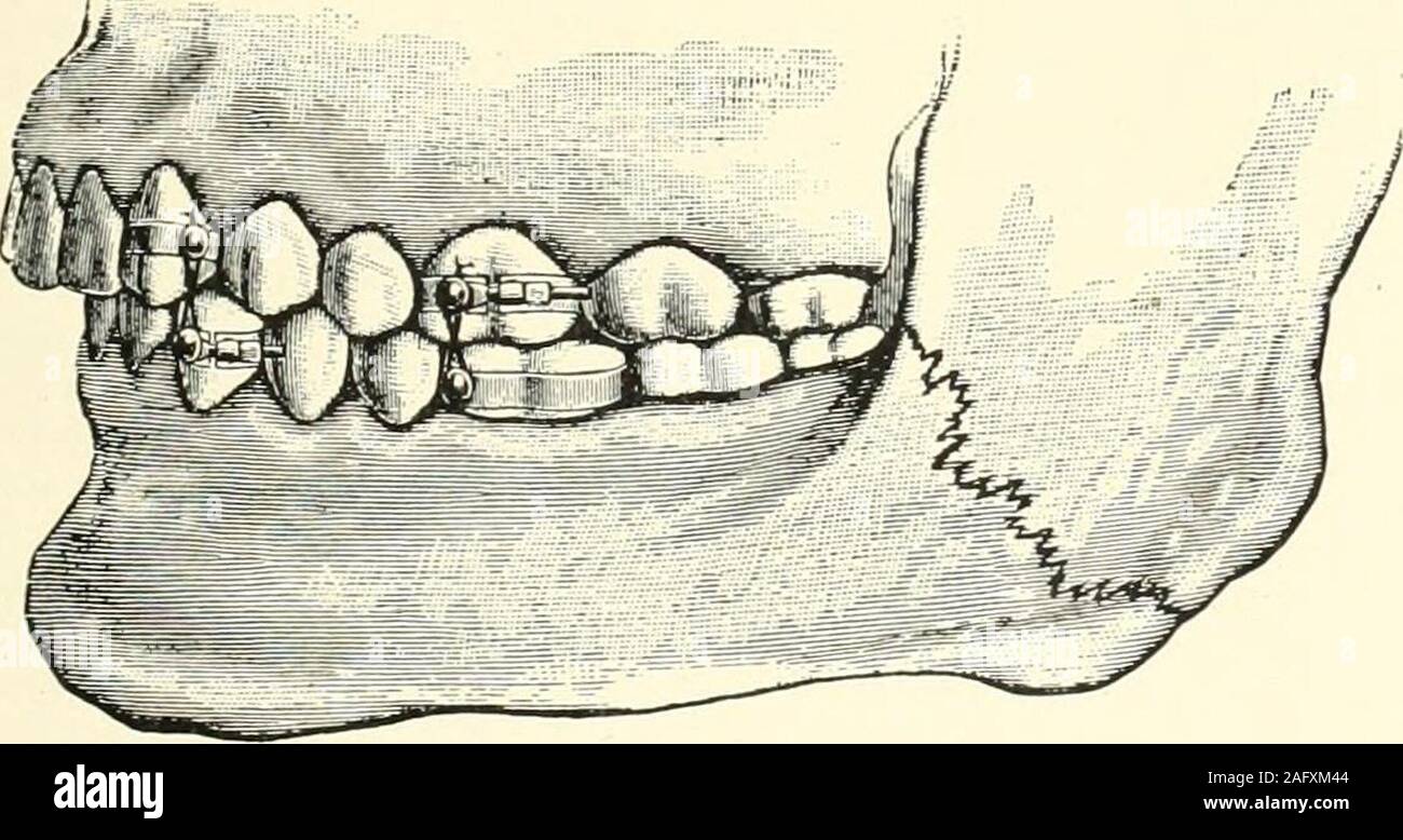 . The science and practice of dental surgery. Fig. 929.—Angles Fracture Bands.(AuGliE : Malocclusion of the Teeth and Fracture of the Maxillae.) other operators, and with modern antisepticmethods it is likely that the disadvantagesattendant upon A^dring in former days mightbe avoided. In that case it certainly has manyadvantages over splints. Successful cases arerecorded by Marshall (10). A metliod of comparatively recent intro-duction is that of E. H. Angle (2), and it hasbeen successfully employed in the United Statesand in Europe (see Fig. 929). Small Germansilver bands with a very small sc Stock Photo