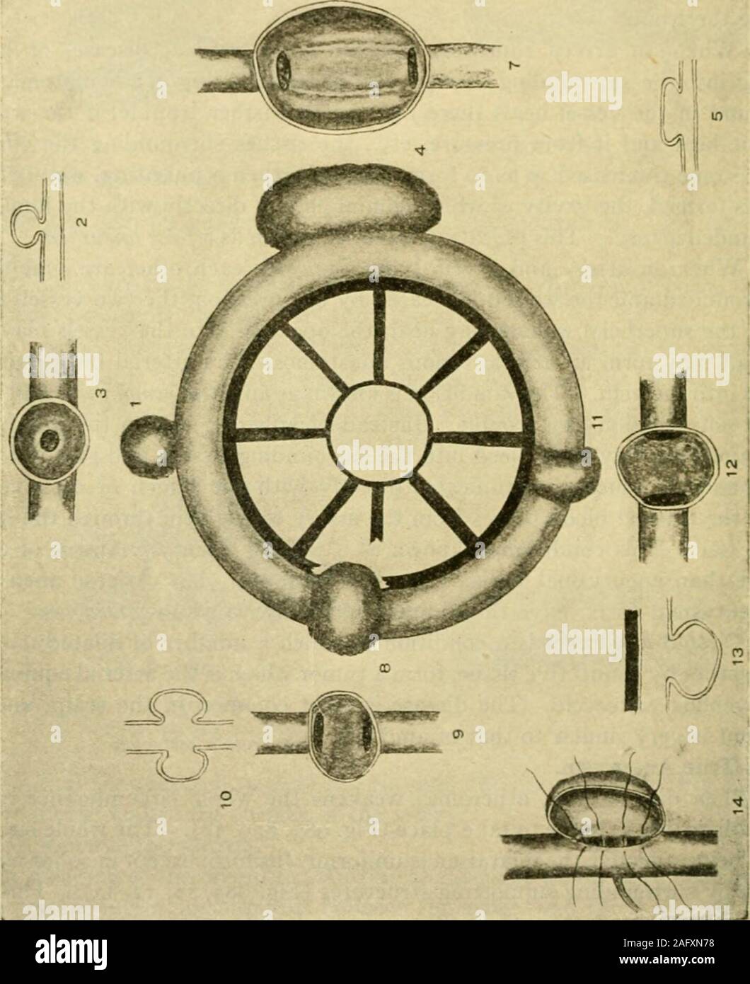 . Manual of operative surgery. , 12, 13). This is afusiform aneurysm. 2