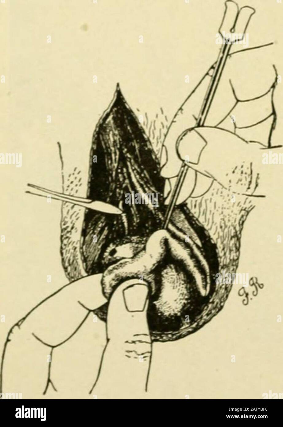 Vasectomy High Resolution Stock Photography and Images - Alamy