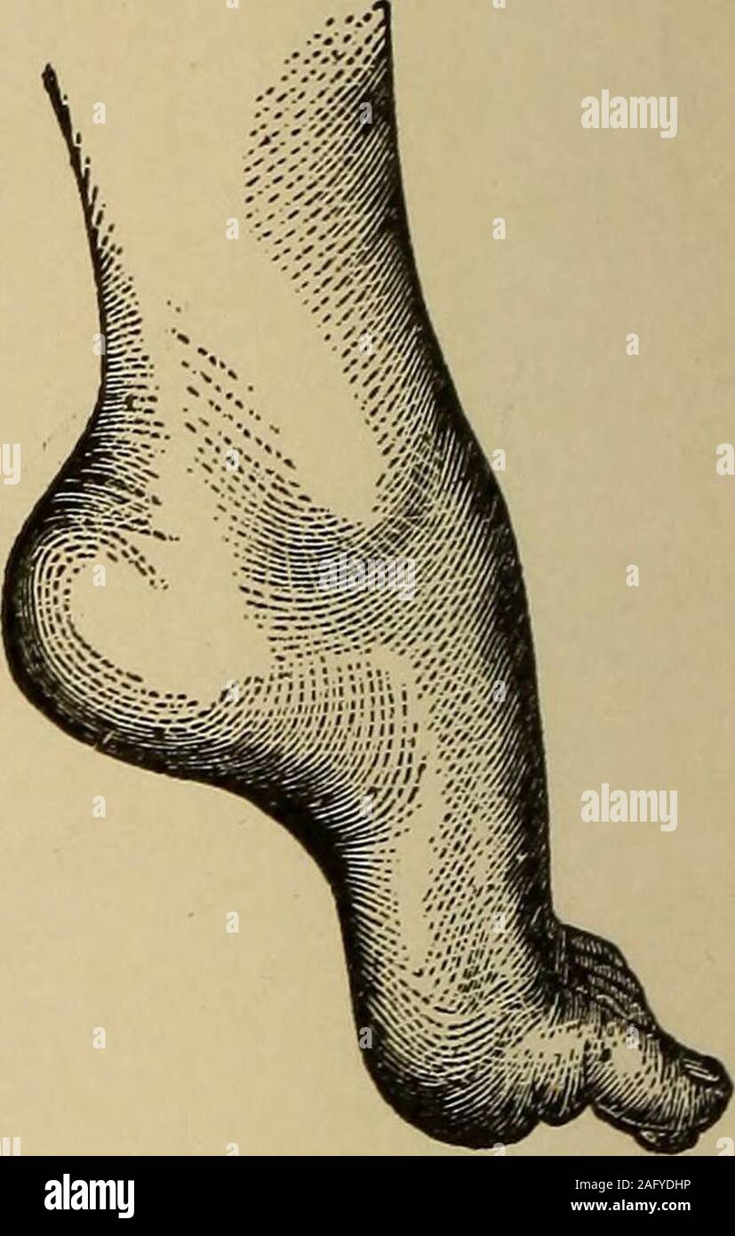 . A treatise on the nervous diseases of children, for physicians and students. Fig. 26. — Pes Equinus in a BoyFive Years of Age from Atrophyof Tibialis Anticus.. Fig. 27.— Pes Equinus ofEight Years Duration. Tibialis AnticusExtensor Digit. Commun. Longus. Peroneus Brevis ^Extensor Hallucis Longus Dorsal Interossei | Stock Photo