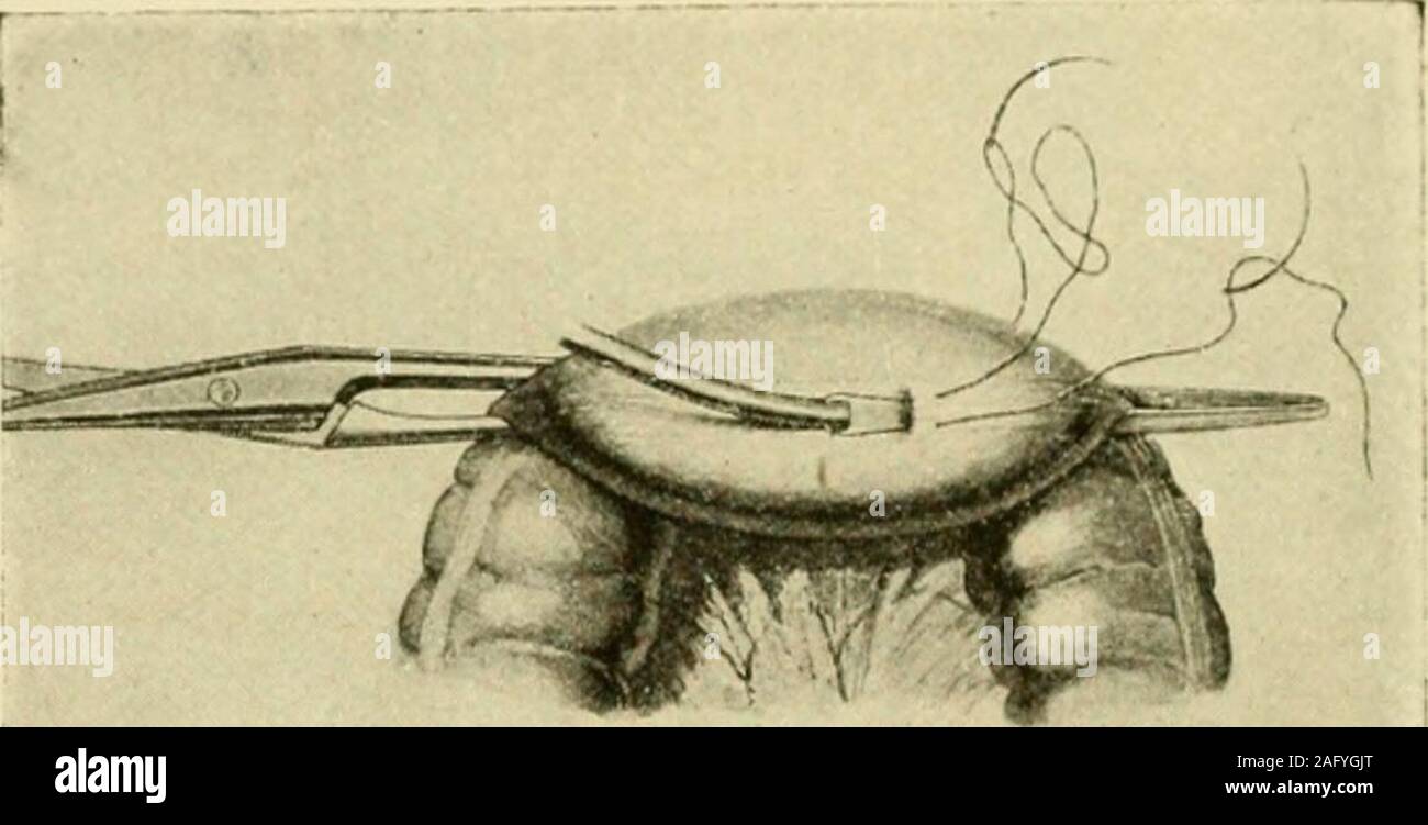 Distal ureter hires stock photography and images Alamy