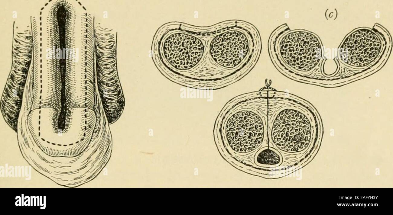 . Manual of operative surgery. ectionable, hence Rosenbergers ingenious