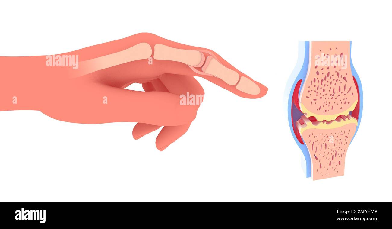 3d illustration of synovial joint with osteoarthritis. Next to the graphic representation of a hand placing the joint. Stock Photo