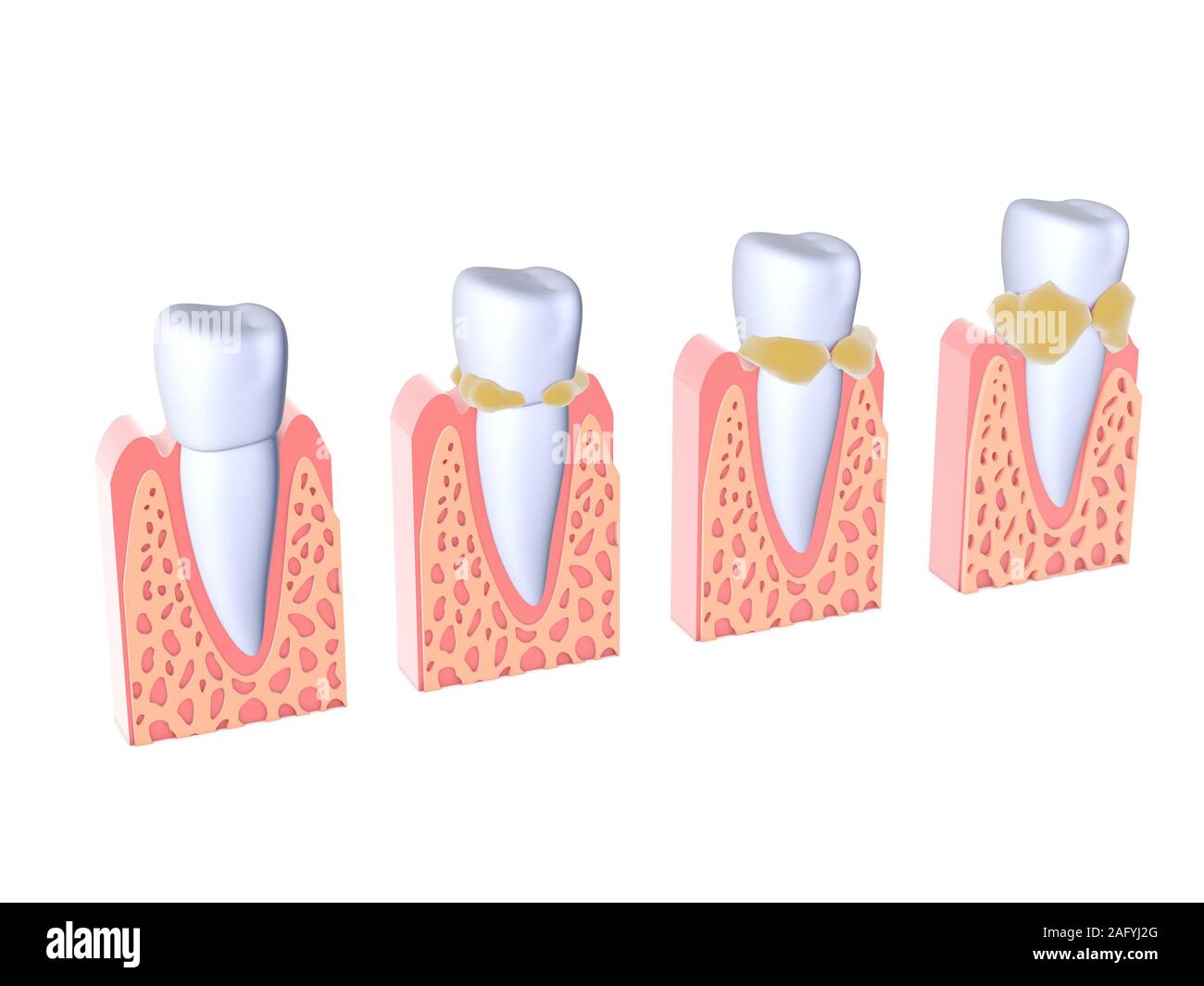 3d illustration of teeth with tartar. Showing four different phases in which it evolves and the gums. Isolated images standing on white background. Stock Photo