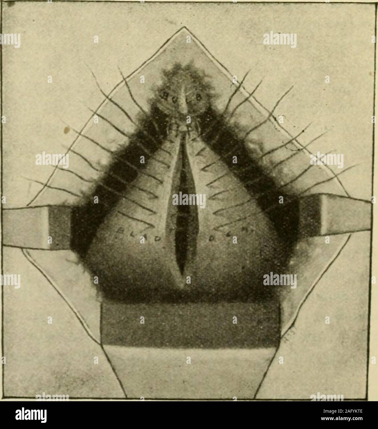 . Manual of operative surgery. Fig. 868.—Prostatectomy for cancer. {Voung, Annals of Surg.). Fig. 869.—Prostatectomy for cancer. (Young, Annals of Surg.) MCKILLOP S OPERATION 71I well exposed. (Fig. 868.) With a scalpel continue the transverse cutin ^ the bladder across the trigone, leaving the upper angles of the trigone in-tact and the ureters uninjured. By blunt dissection through the wound inthe bladder complete the exposure of the seminal vesicles, pick up the vasadeferentia and divide them as high as possible. Remember that the vasadeferentia pass around the lower end of the ureters whic Stock Photo