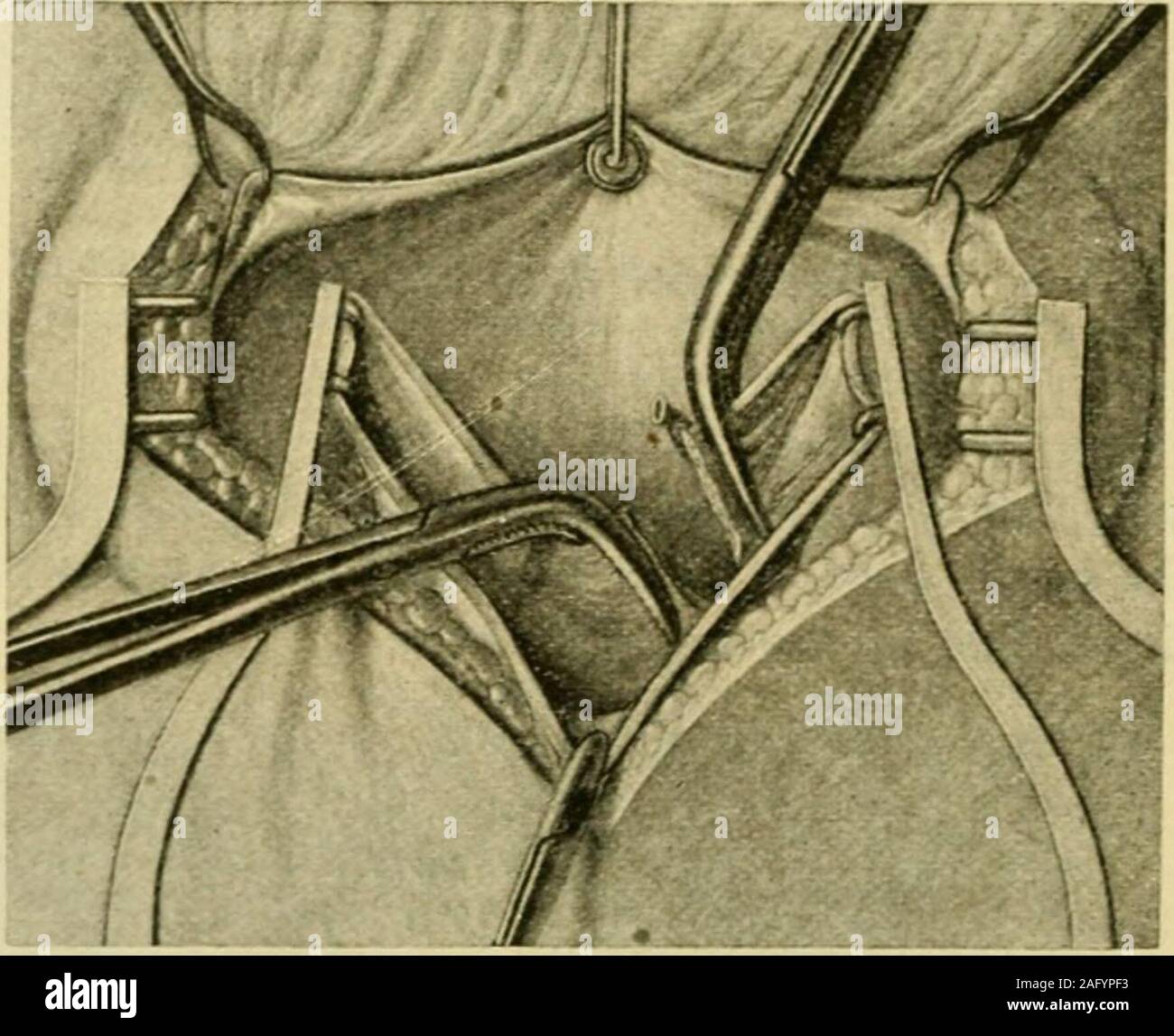 . Manual of operative surgery. Fig. 854.—(Squier and Heyd, Surg., Gyn