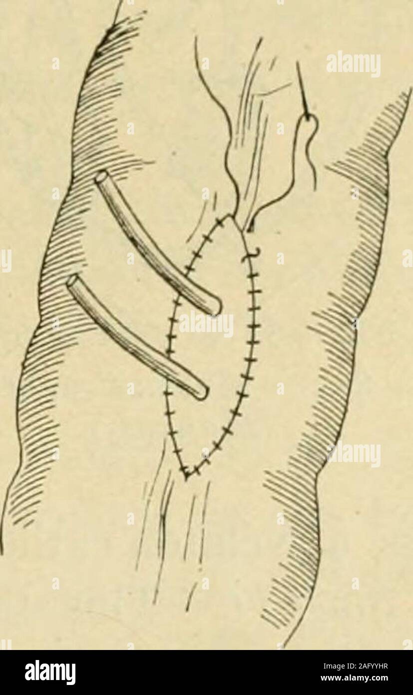 Blad bladder hi-res stock photography and images - Alamy