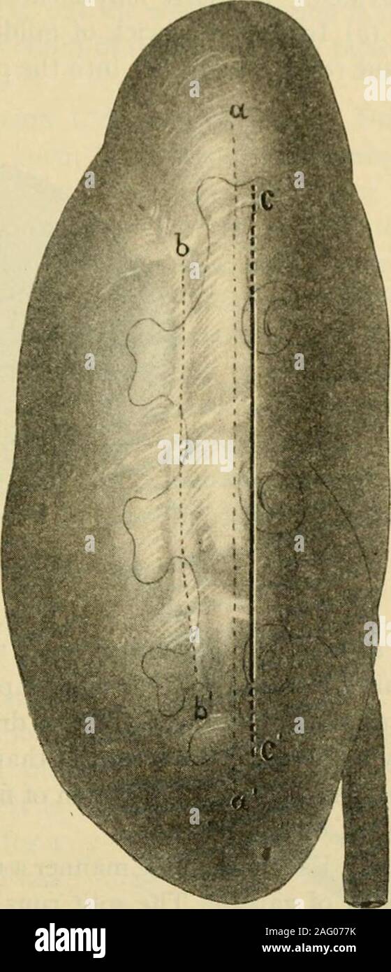 Lumbar incision hi-res stock photography and images - Alamy