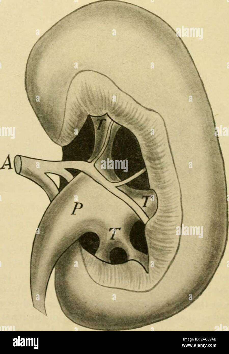 . Manual of operative surgery. Fig. 787.—{Poirier and Charpey.). Fig. 788. EXPLORATION KIDNEY 645 around the calices (Figs. 789 and 790). In the fatty tissue of the renal sinus liethe lymphatics and nerves of the kidney. From the preceding paragraphs it might seem that the sinus of the kidneywas always the same shape and bore the same relationship to the pelvis. Thiswould be far from the truth. Fig. 791 shows a kidney in which there is little notching of the inner borderof the kidney and in which most of the renal pelvis lies in an accessible position, Stock Photo