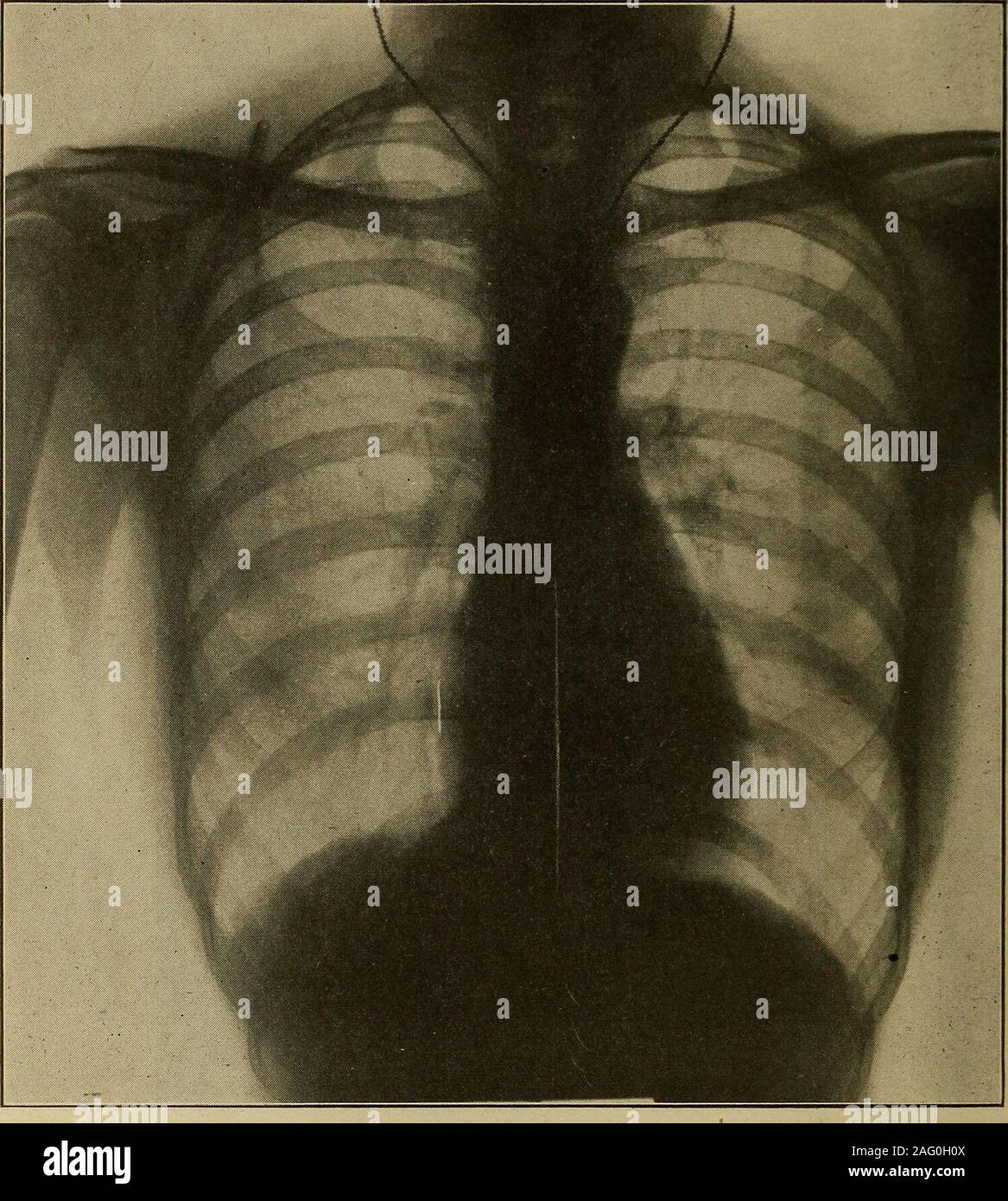 . Medical diagnosis for the student and practitioner. Fig. 309.—Drop heart. It will be noted that the right border is hidden by the sternum-Ml. in this case is 5 cm. infrequently, a more or less decided but demonstrable shrinkage in the cardiacarea of what may have seemed originally to be a heart of normal dimensions, butwhich proves to have been a dilated drop. As previously stated, a normal transverse diameter, as usually defined, The cardinalrepresents in the heart of the congenital asthenic an enlargement, or, in 604 MEDICAL DIAGNOSIS Deceptivemeasurements. Such heartsQf ten adequate. othe Stock Photo