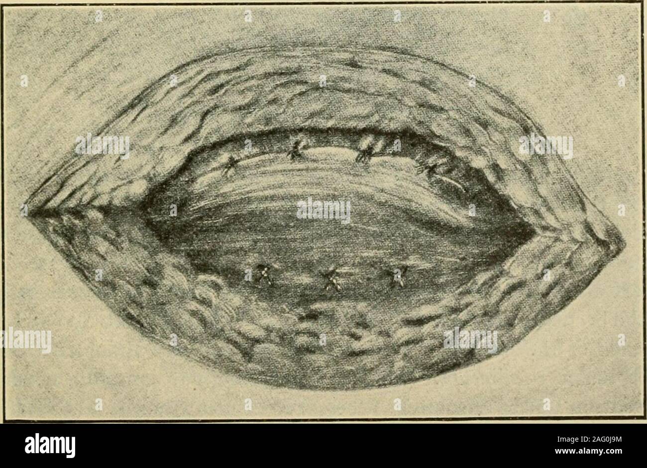 . Manual of operative surgery. Fig. 762.—Mayos operation. Umbilical