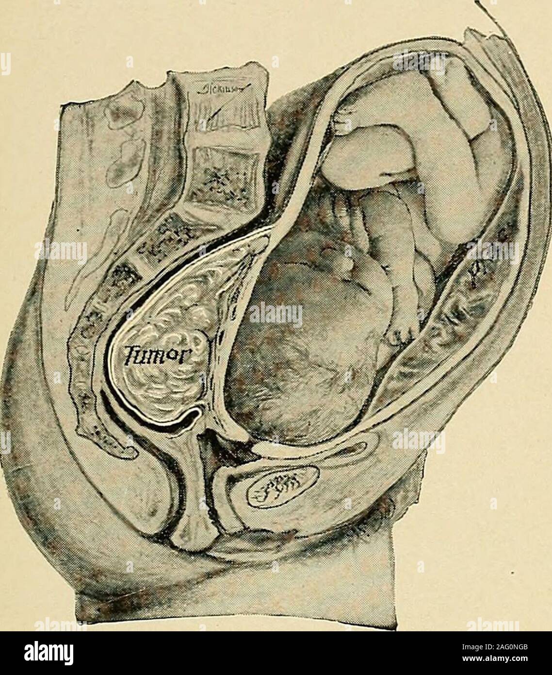 the diagnosis and treatment of diseases of women fig 379 fibroid tumor and pregnancy thetumor forming the most of the mass dudleypractice of gynecology uterus enlarged from other causes 255 because of atresia of the cervix hematometra fig 381 or from a collection of puspyometra or of pus and gas pyophysometra fig 382 softening of the corpus uteri is caused by the various forms of intra uterine preg nancy in most cases of early pregnancy the characteristic compressibility of aportion of the uterus hegars sign may be made out and when well marked is of fig 380 fibroi 2AG0NGB
