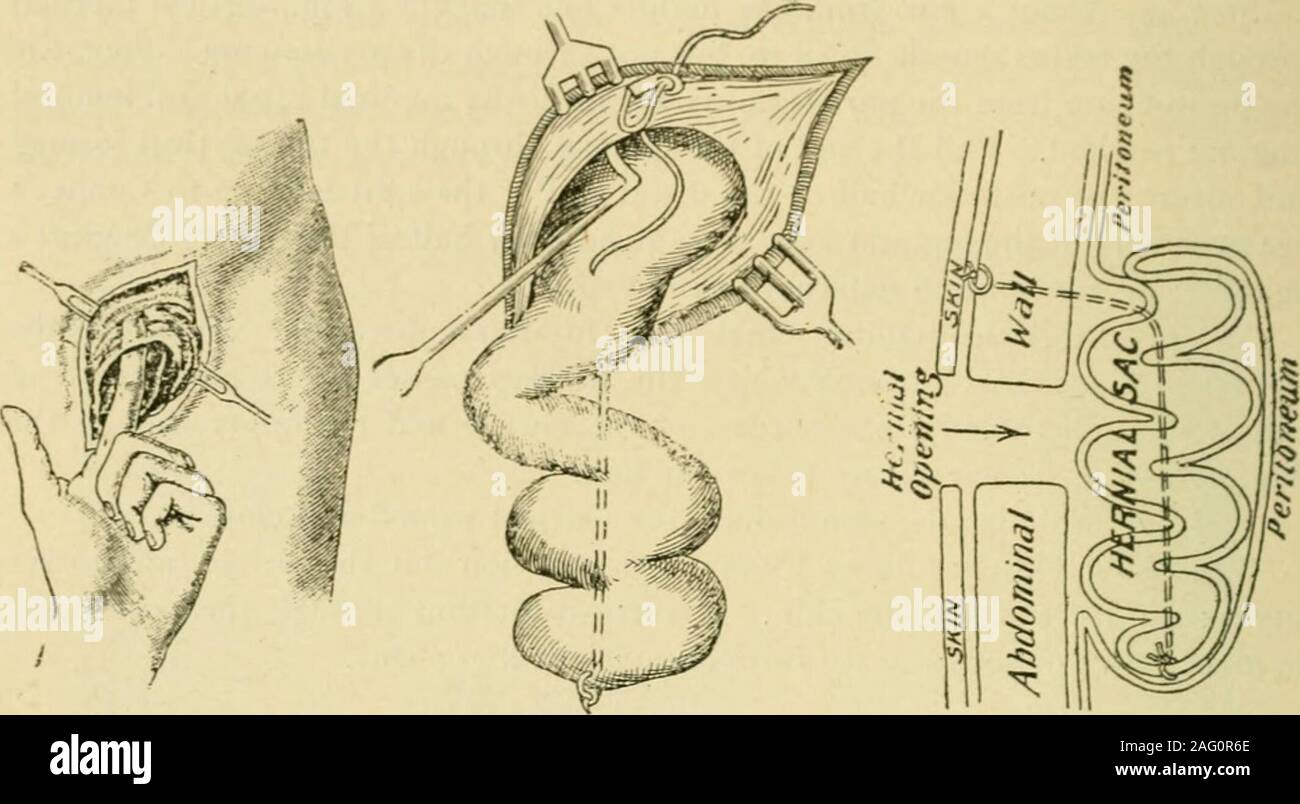 Manual of operative surgery. s over the hernialneck. Expose the upper part  of the sac of the hernia. 2. By blunt dissection free the sac from its  surroundings and from thespermatic