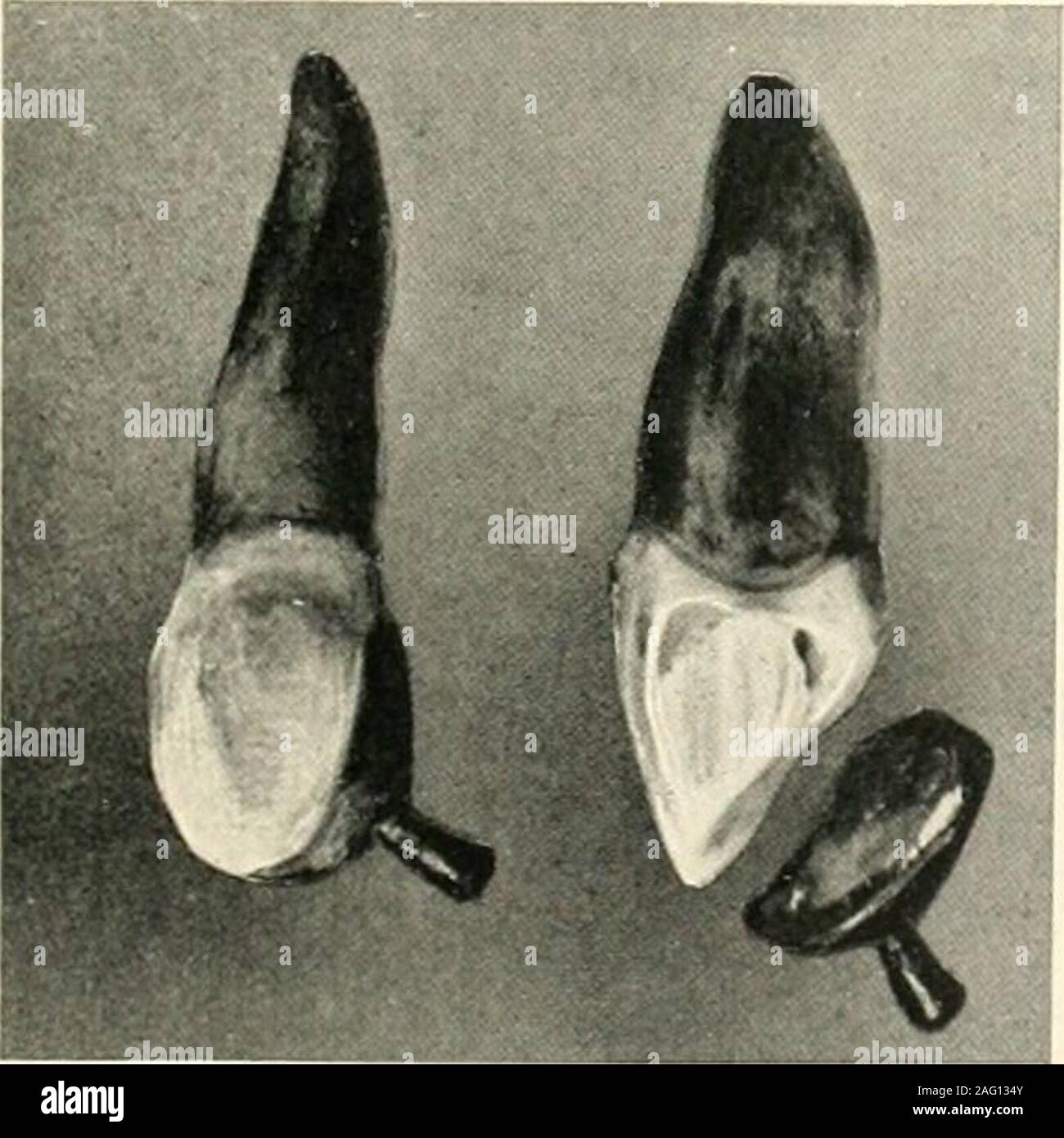 . The science and practice of dental surgery. Fig. 504. form necessary for retention may be cut in thecement that replaces the carious parts. Fig. 509 shows good preparation in bilateralcaries, with abrasion, of an incisor ; Fig. 510,abrasion of the canme.. Fio. 505. Fig. 512 is an example of recurrent approximalcaries usual at the margins of small cavitiesfilled without extension to immune areas. Cavities that reach the Gingival Line.—In cariesof a molar or premolar extending to the gmgival line or beyond it, as in Figs. 492, 493, and 501,and the medial surfaces of Figs. 496 and 499, satis-fa Stock Photo