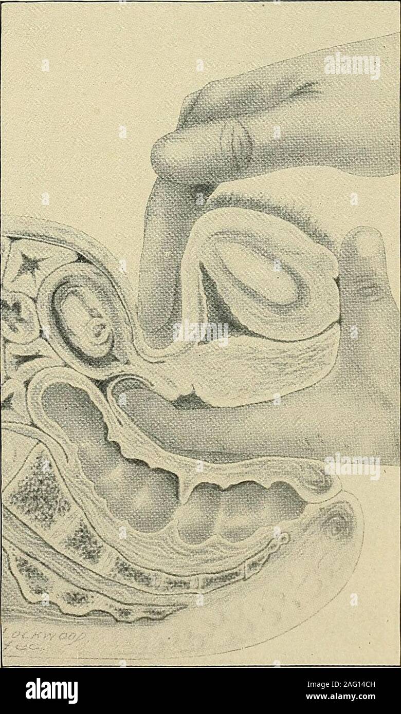 . The diagnosis and treatment of diseases of women. Fig. 353. Palpating ...