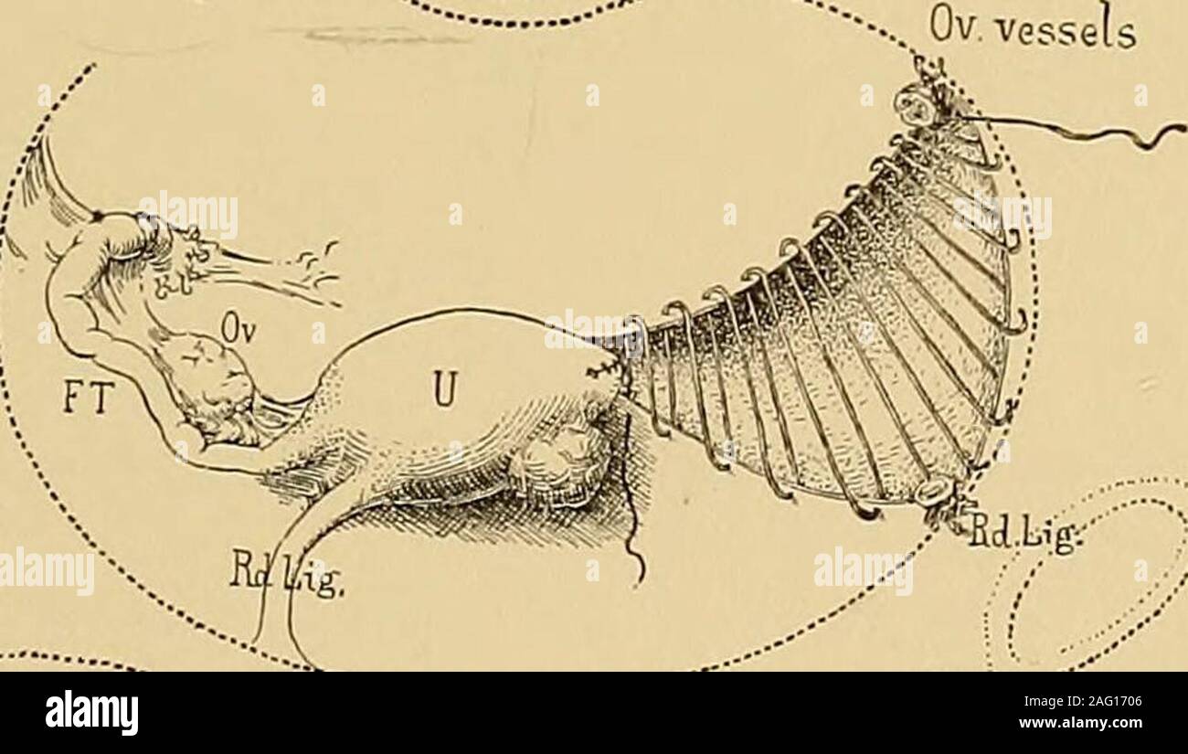 Operative Gynecology Fig 443 Diagram Fkom A Case Of Intraltg Cyst Seen From Above Showing The Relations Of The Separated Peritoneal Layers Of The Left Broad Ligament To The Cyst And Theuterine