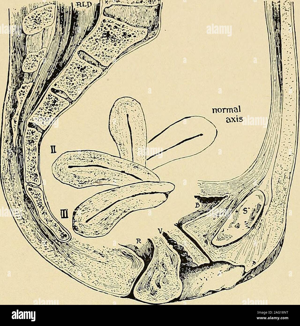 The diagnosis and treatment of diseases of women. ap-parently continuous  with the cervix, and of the size, shape and consistency of thecorpus uteri  (Figs. 70, 71). It may be movable or