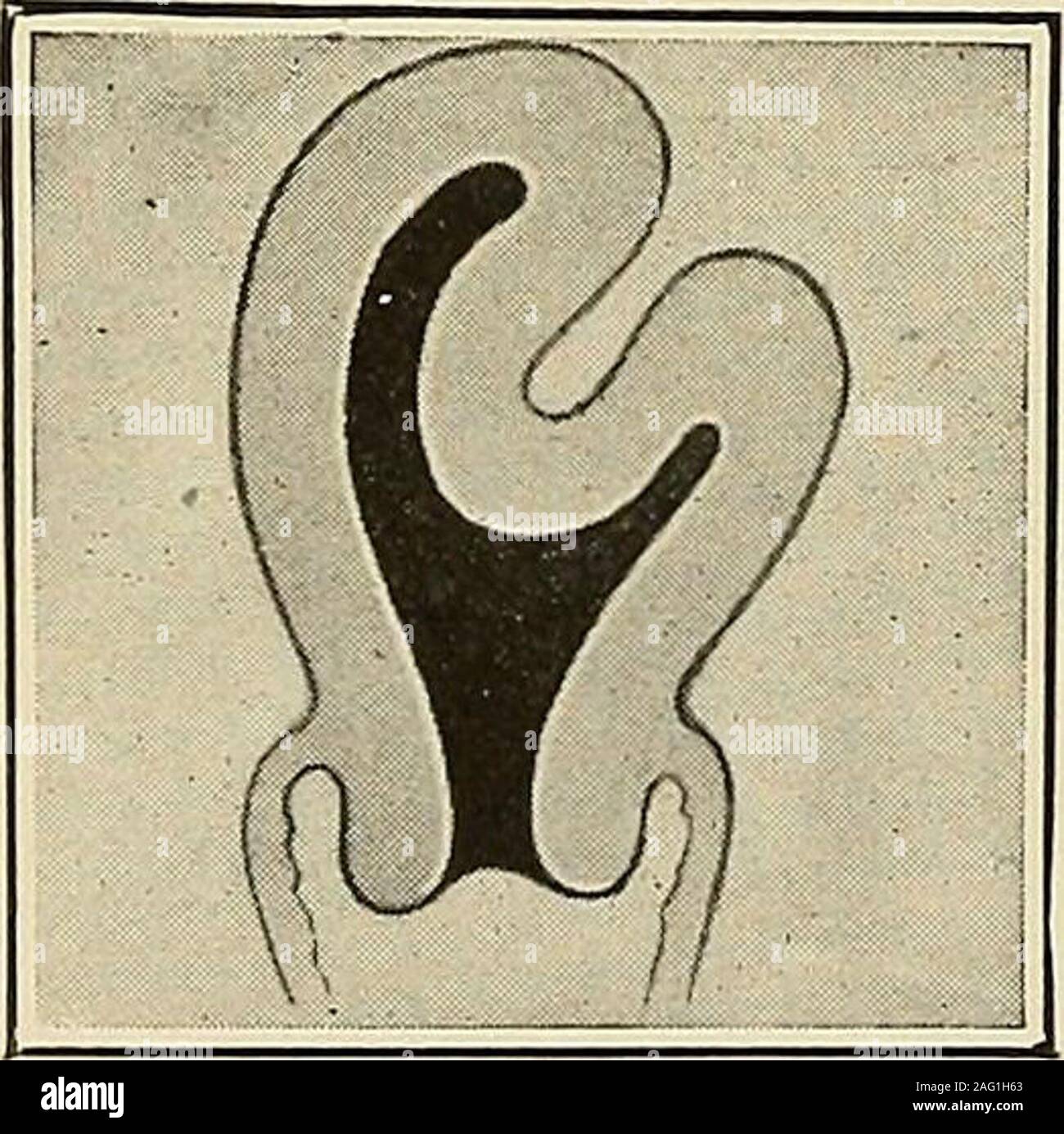 . The diagnosis and treatment of diseases of women. Fig. 312. Inversion ...
