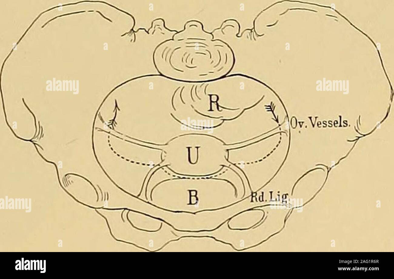 . Operative gynecology. te them witha silk ligatuie passed through