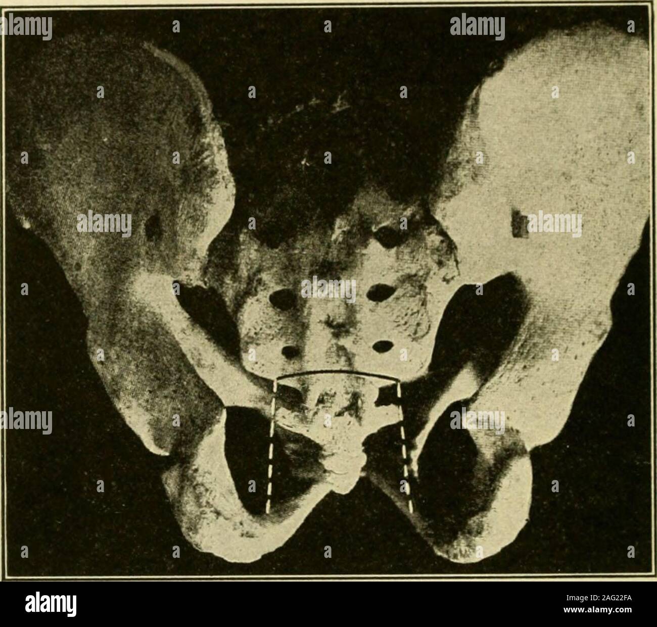 . Manual of operative surgery. d ends (without tension) will be possible after thetumor is removed, the whole wound is loosely packed with iodoform gauzeand the rectum left unopened and not relieved of the tumor. During the after-treatment the patient must lie on his side. Keep the bowels locked up forfive days with opium. On the fifth day move the bowels with castor oil and 494 THE RECTUM enemata. After the lapse of about ten days from the primary operation, excisethe tumor and suture the ends of the gut together. In doing so, first stitchthe mucosa with catgut and then unite the other coats Stock Photo