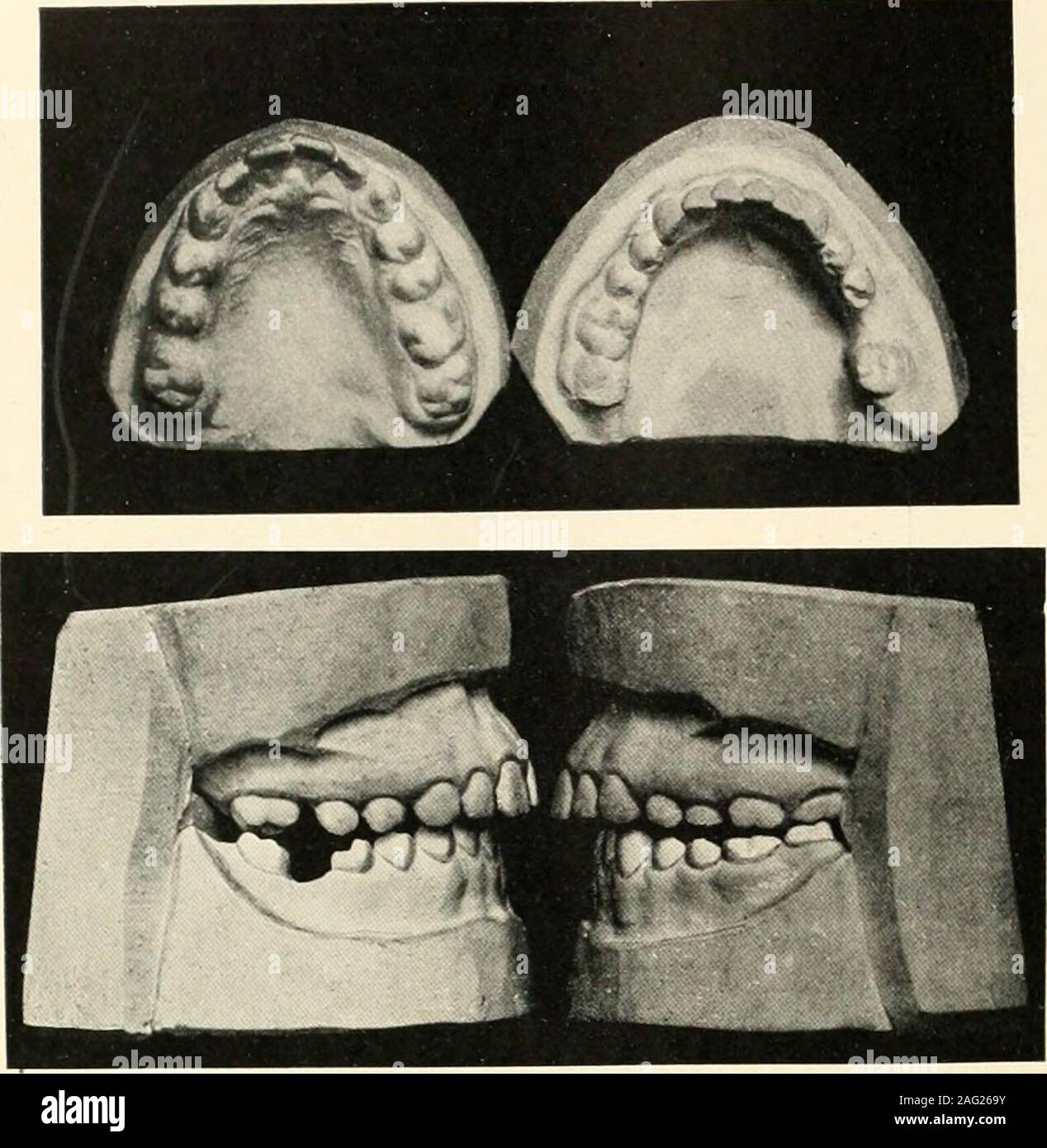 Anterior molars hi-res stock photography and images - Alamy