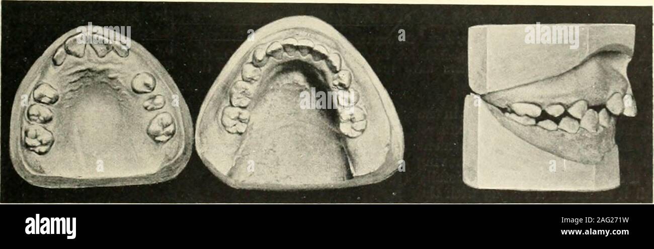 . The science and practice of dental surgery. Fio. 367.—Case 3. Before treatment. Fro. 308.—Case 3. After treatment.. Fig. 369.—Case 4. Before treatment. Stock Photo